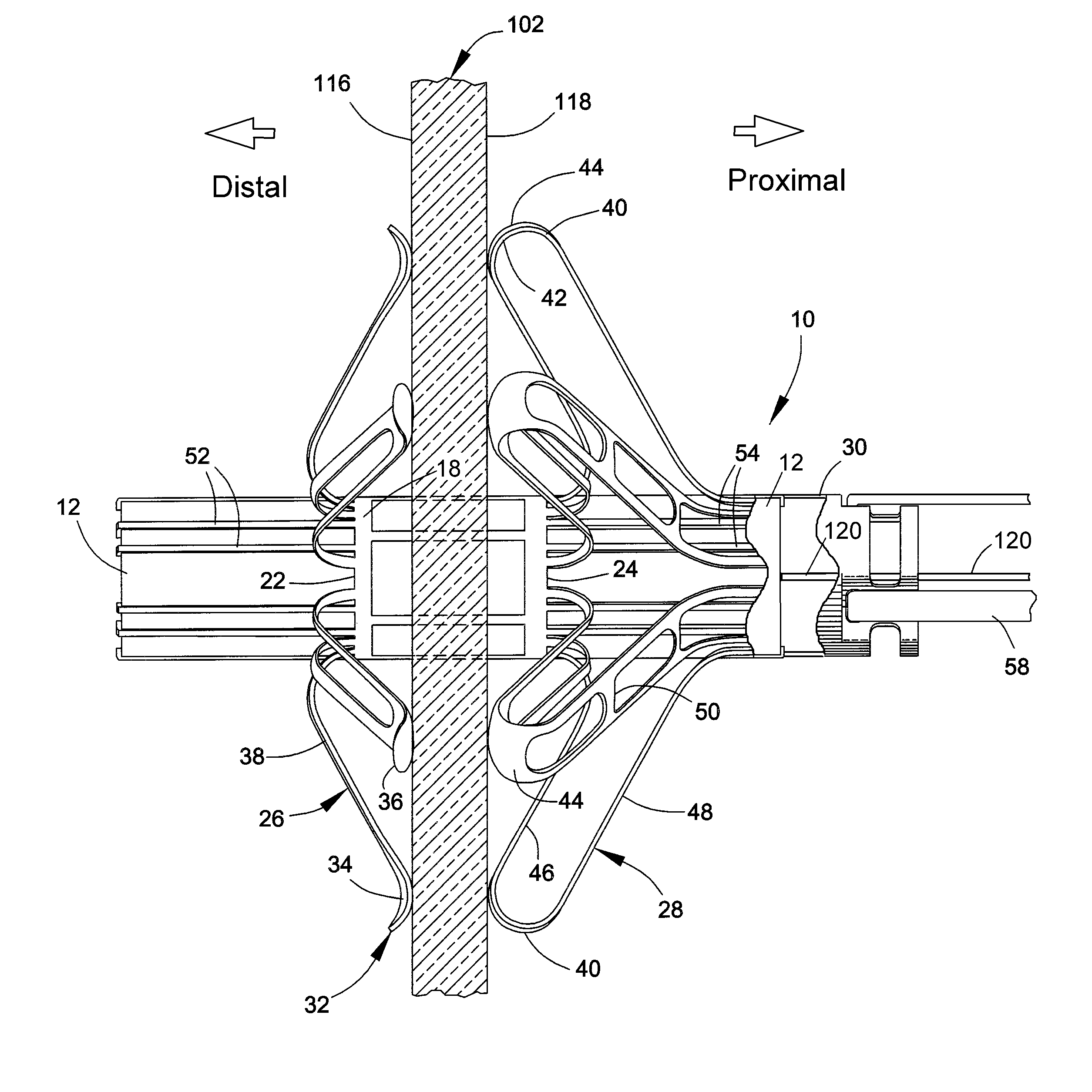 Delivery system, method, and anchor for medical implant placement