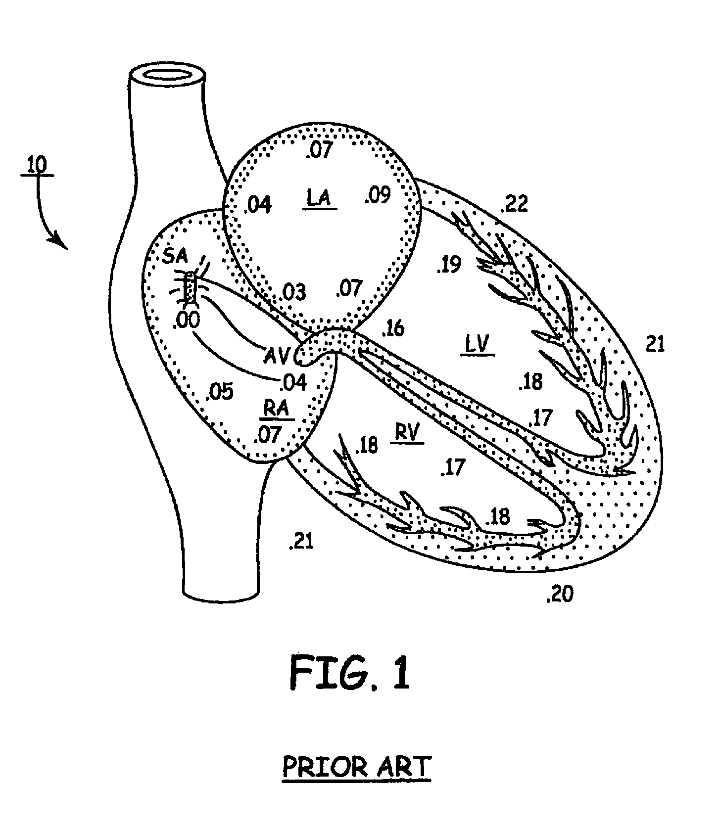 Apparatus and methods of energy efficient, atrial-based Bi-ventricular fusion-pacing