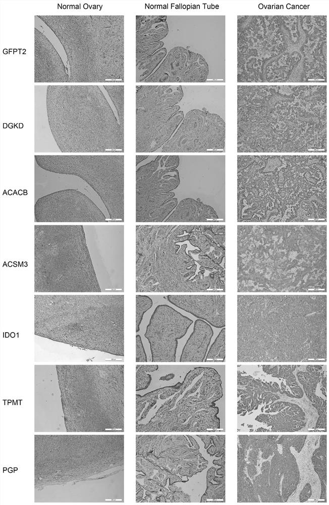 Molecular model for judging prognosis of ovarian cancer patient and application