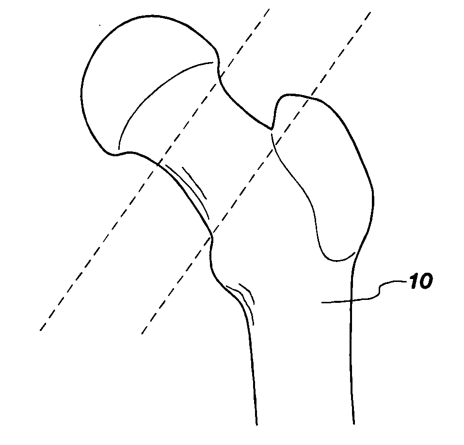 Tissue sparing implant