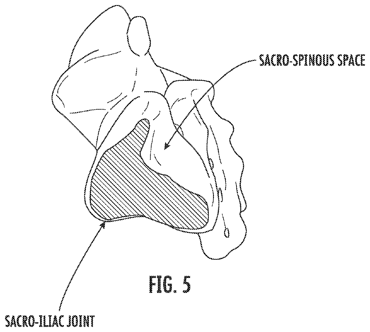 Method for performing spinal surical procedures through the sacral ala