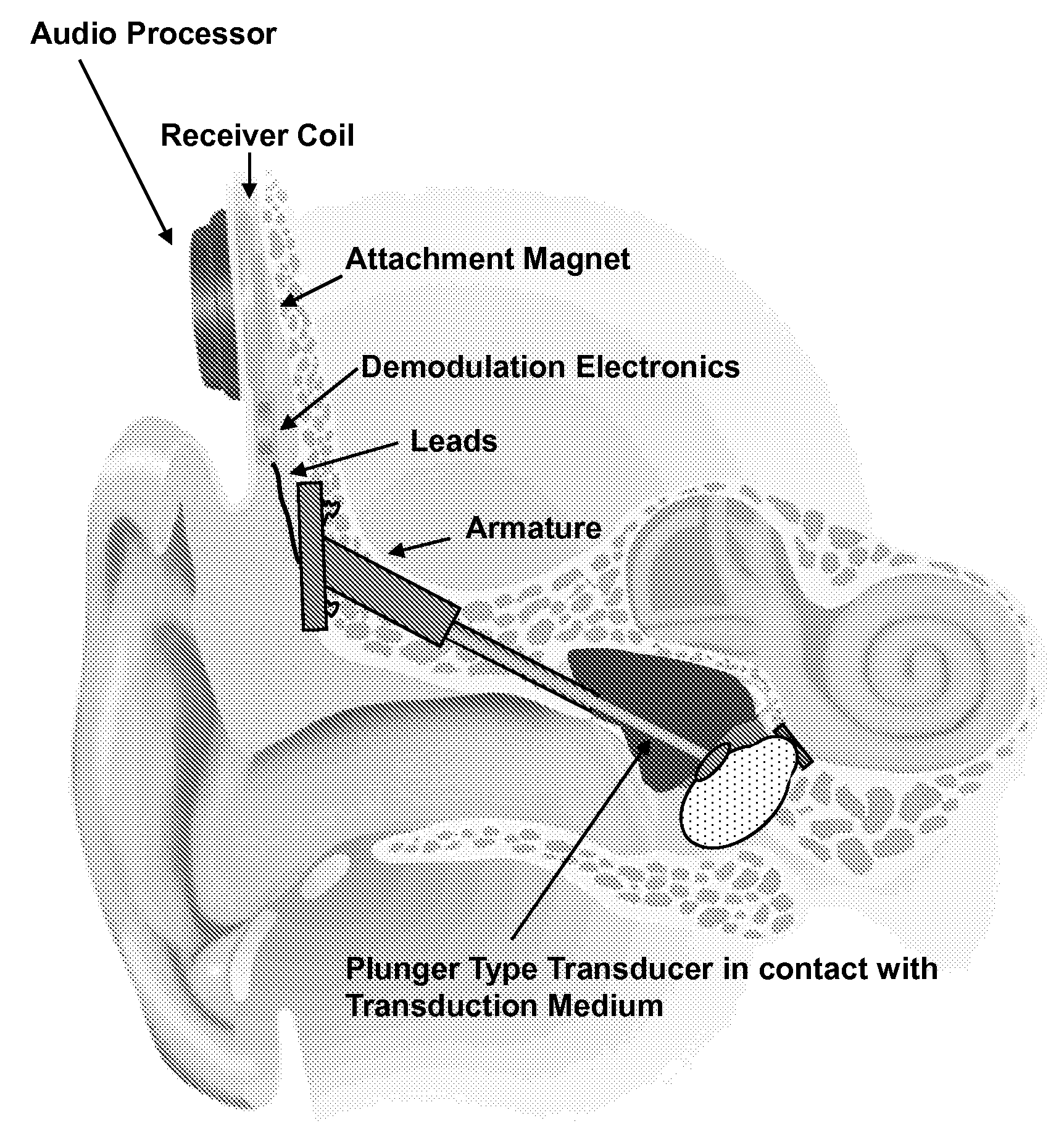 Implantable Auditory Stimulation Systems Having a Transducer and a Transduction Medium