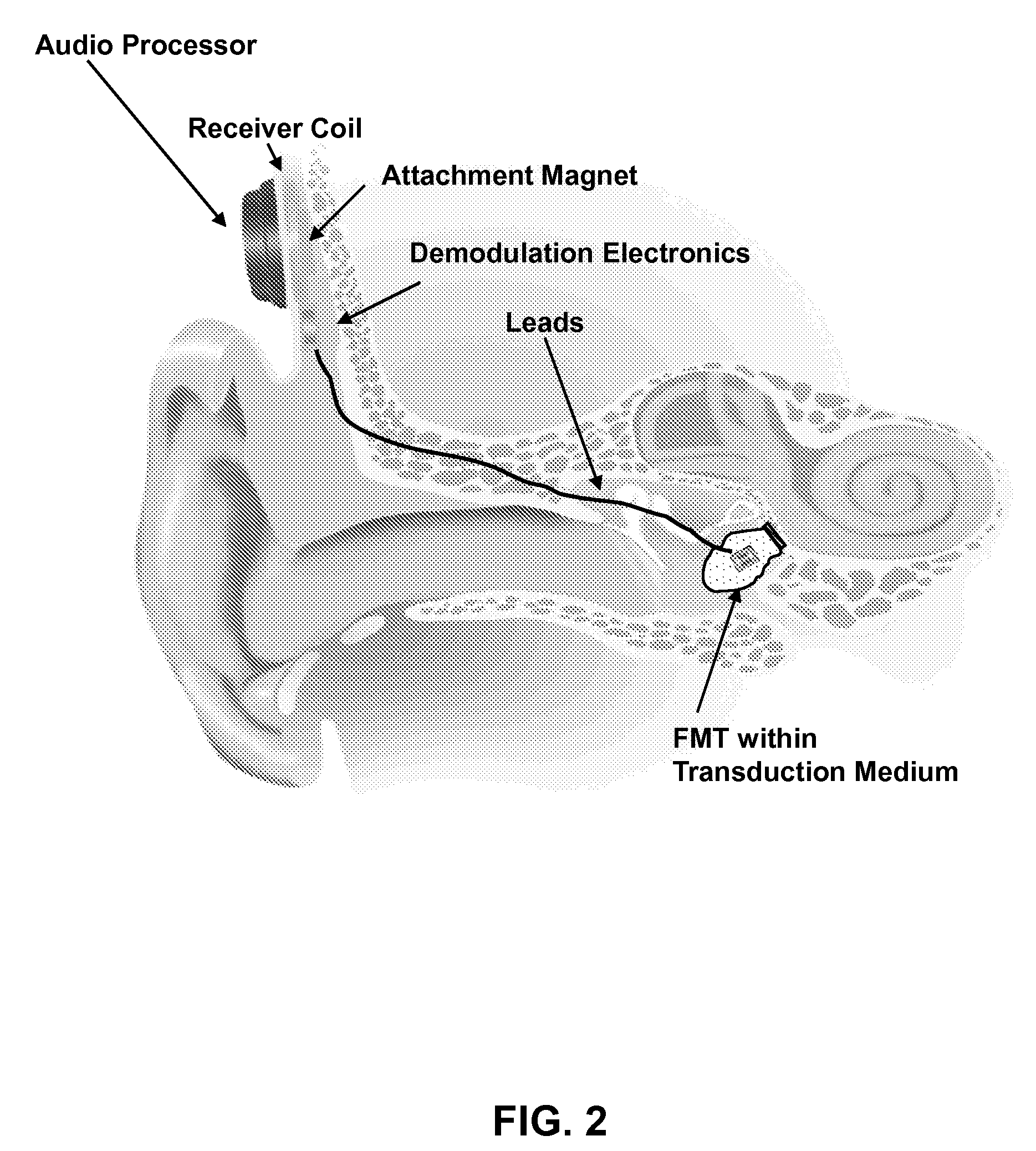 Implantable Auditory Stimulation Systems Having a Transducer and a Transduction Medium