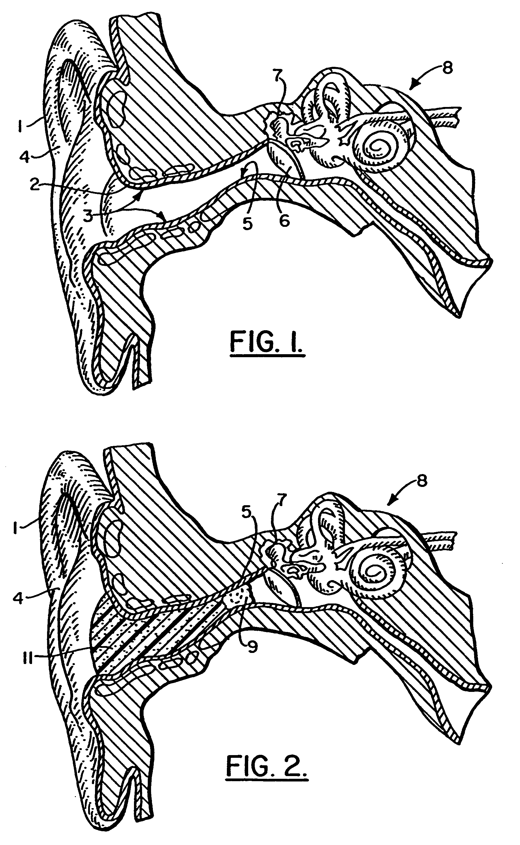 Method of manufacturing a soft hearing aid