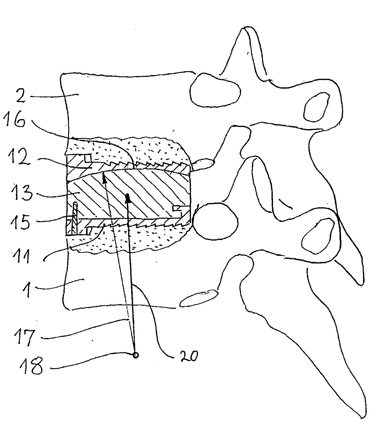 Cervical intervertebral prosthesis system