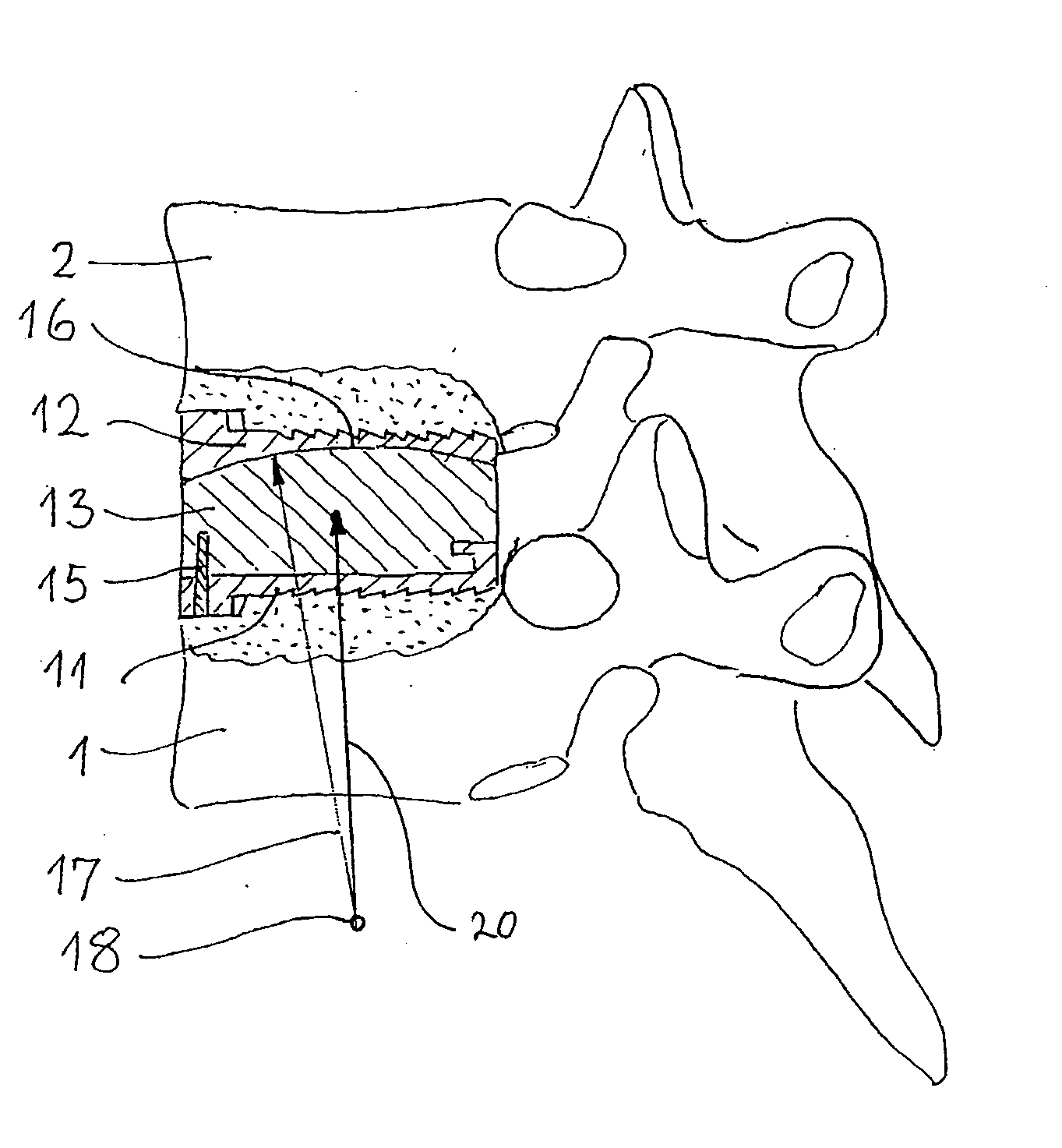 Cervical intervertebral prosthesis system