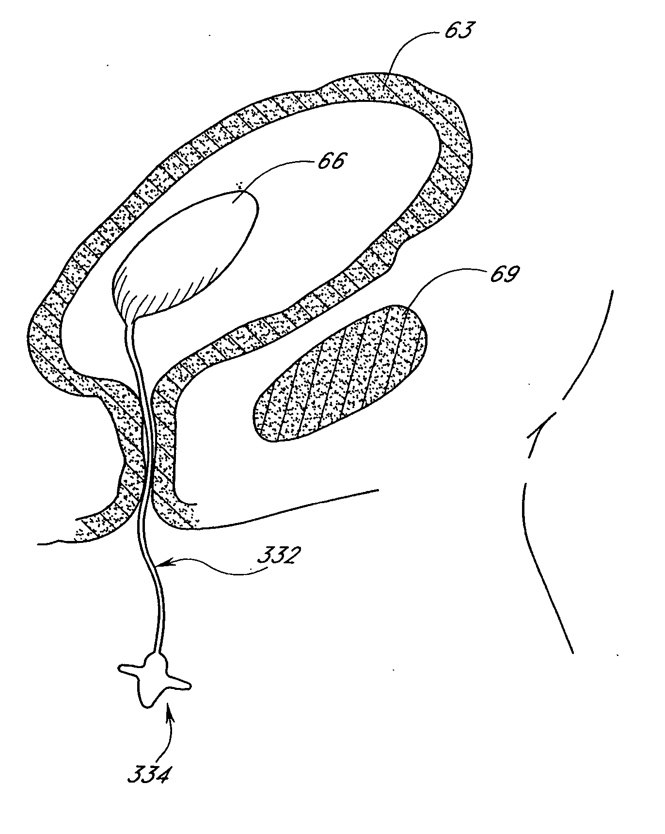 High vapor pressure attenuation device