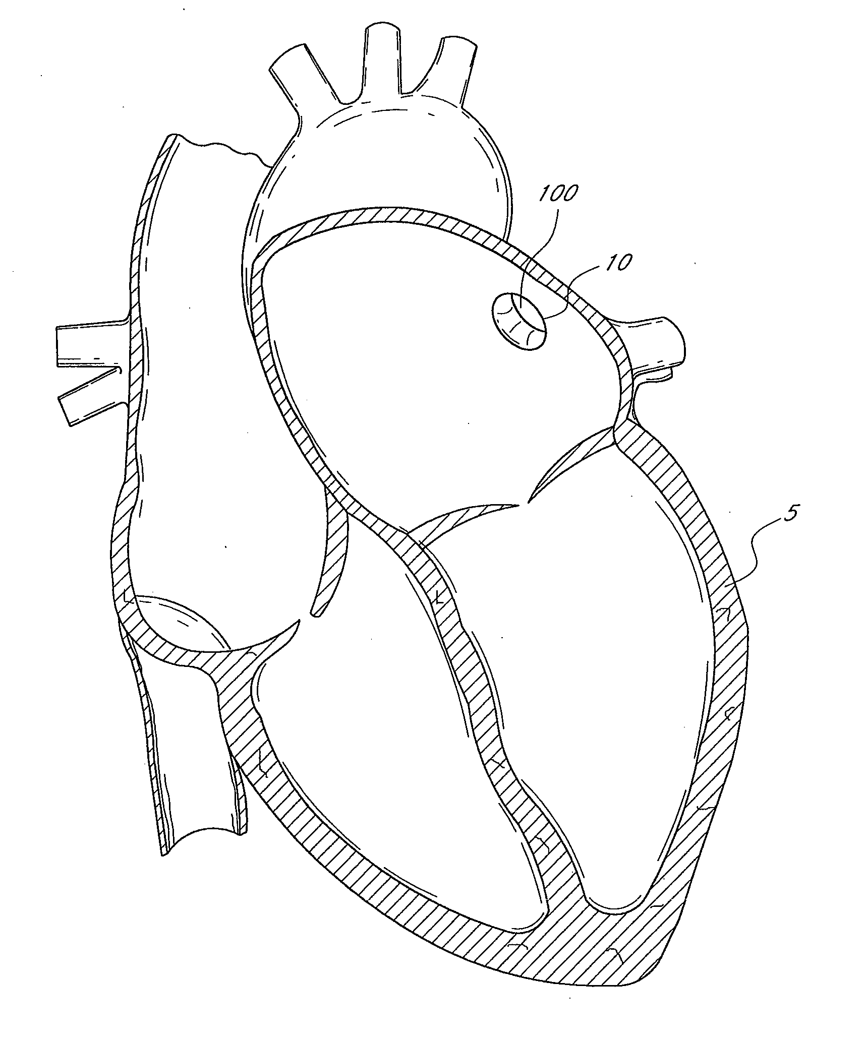 Method and apparatus for delivering an implant without bias to a left atrial appendage