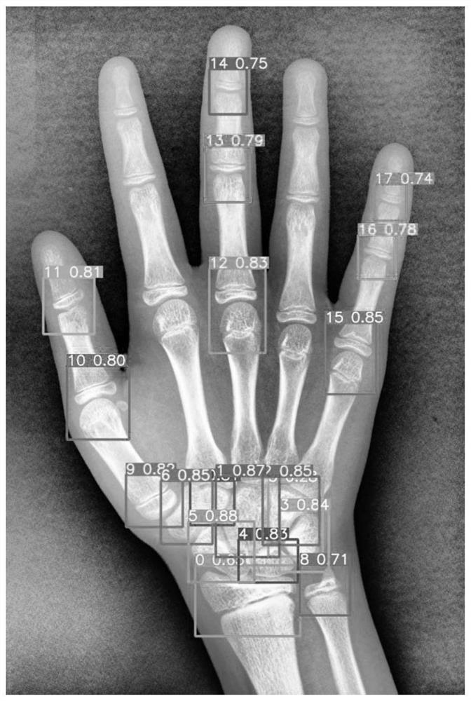 Bone age evaluation method and device based on deep convolutional neural network and feature fusion, and computer readable storage medium