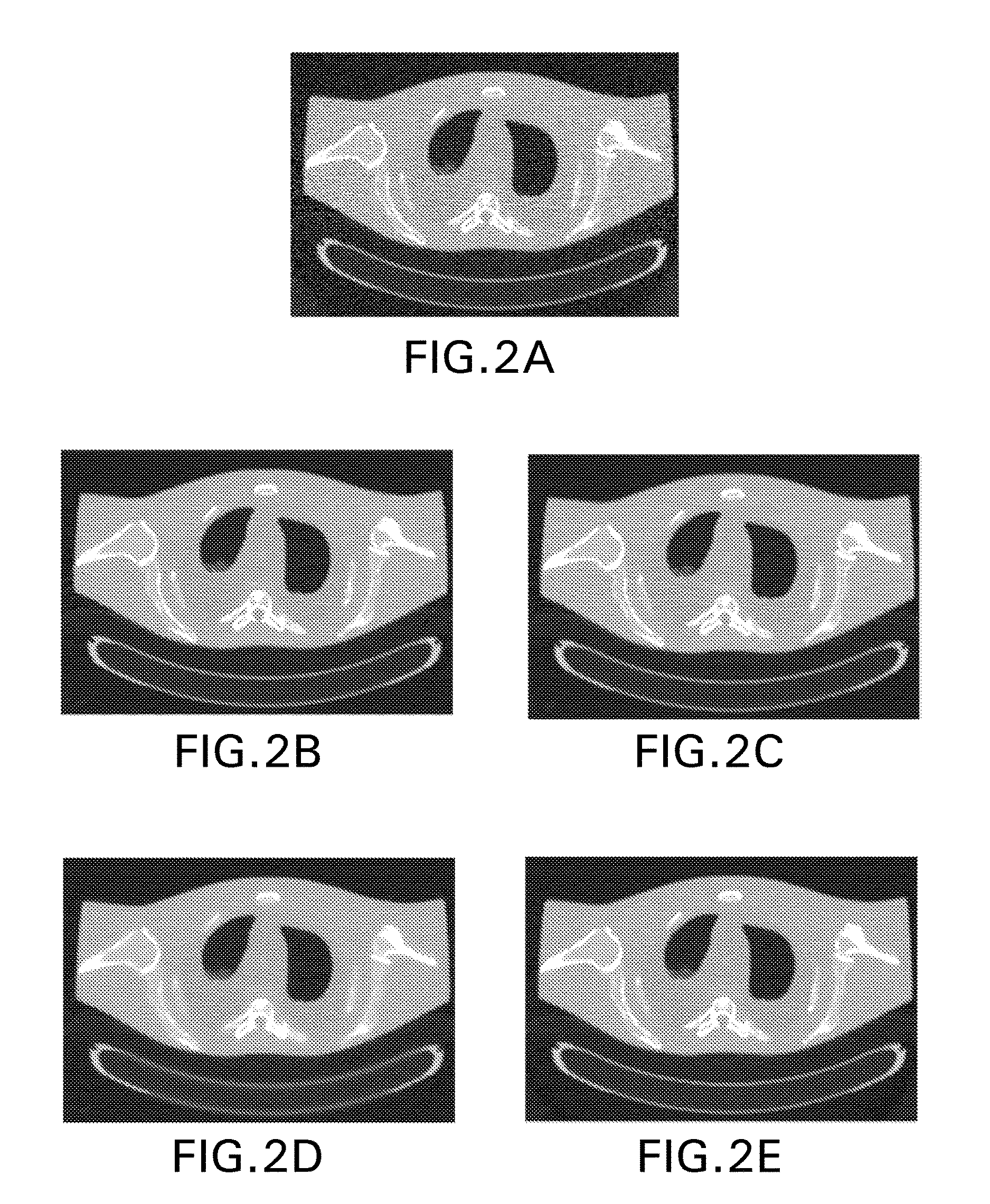 Iterative reconstruction for X-ray computed tomography using prior-image induced nonlocal regularization