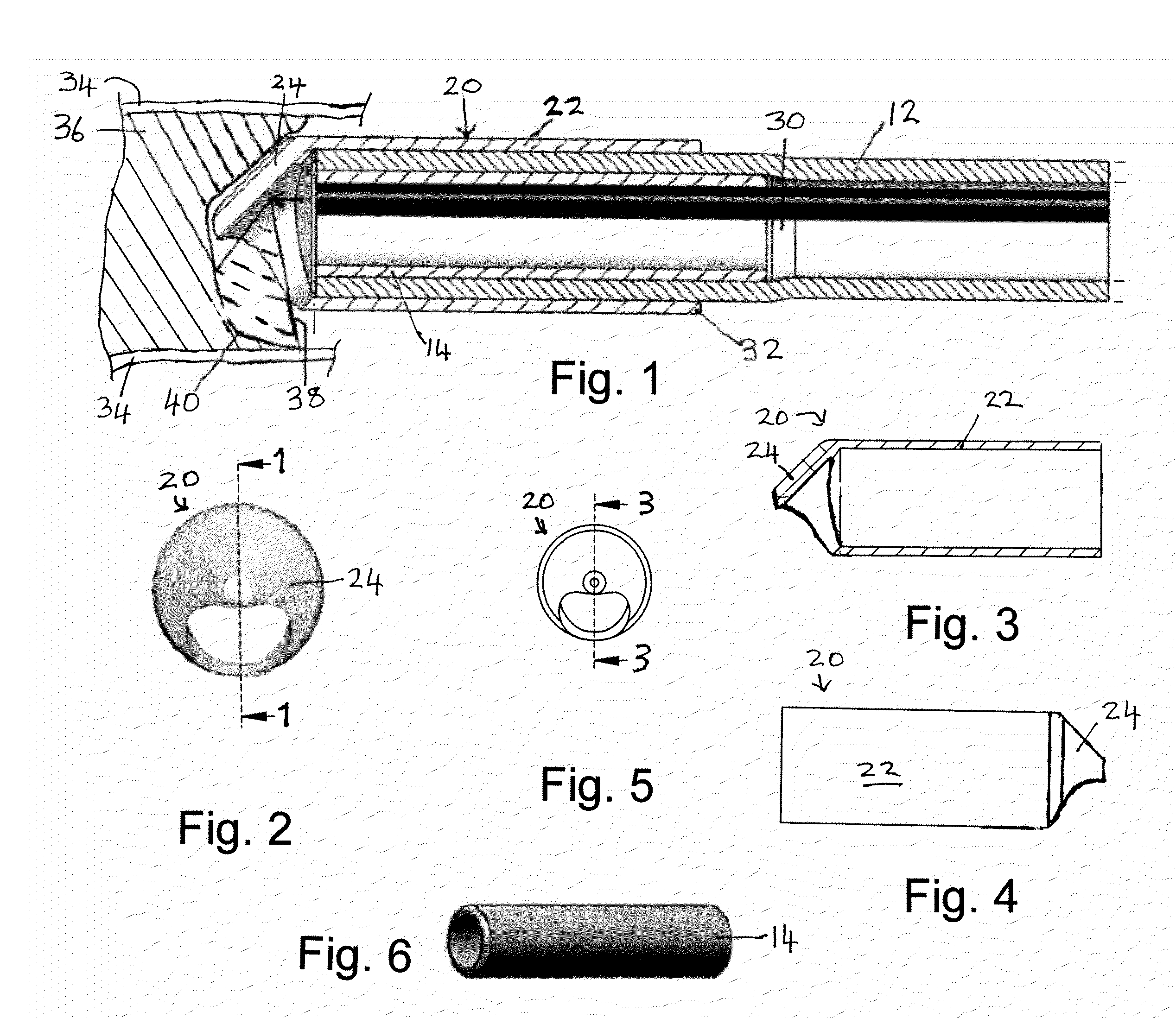 Process and system for treating a vascular occlusion or other endoluminal structure