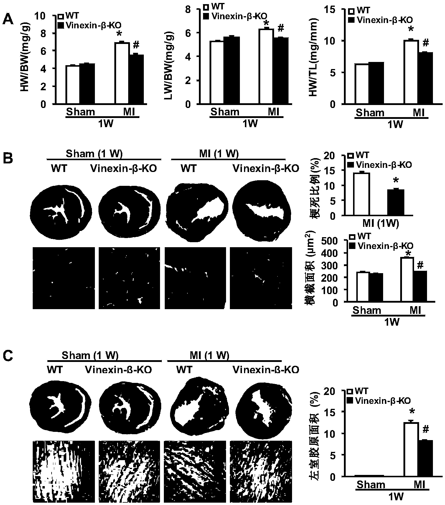 Application of Vinexin-beta gene in coronary atherosclerotic heart disease