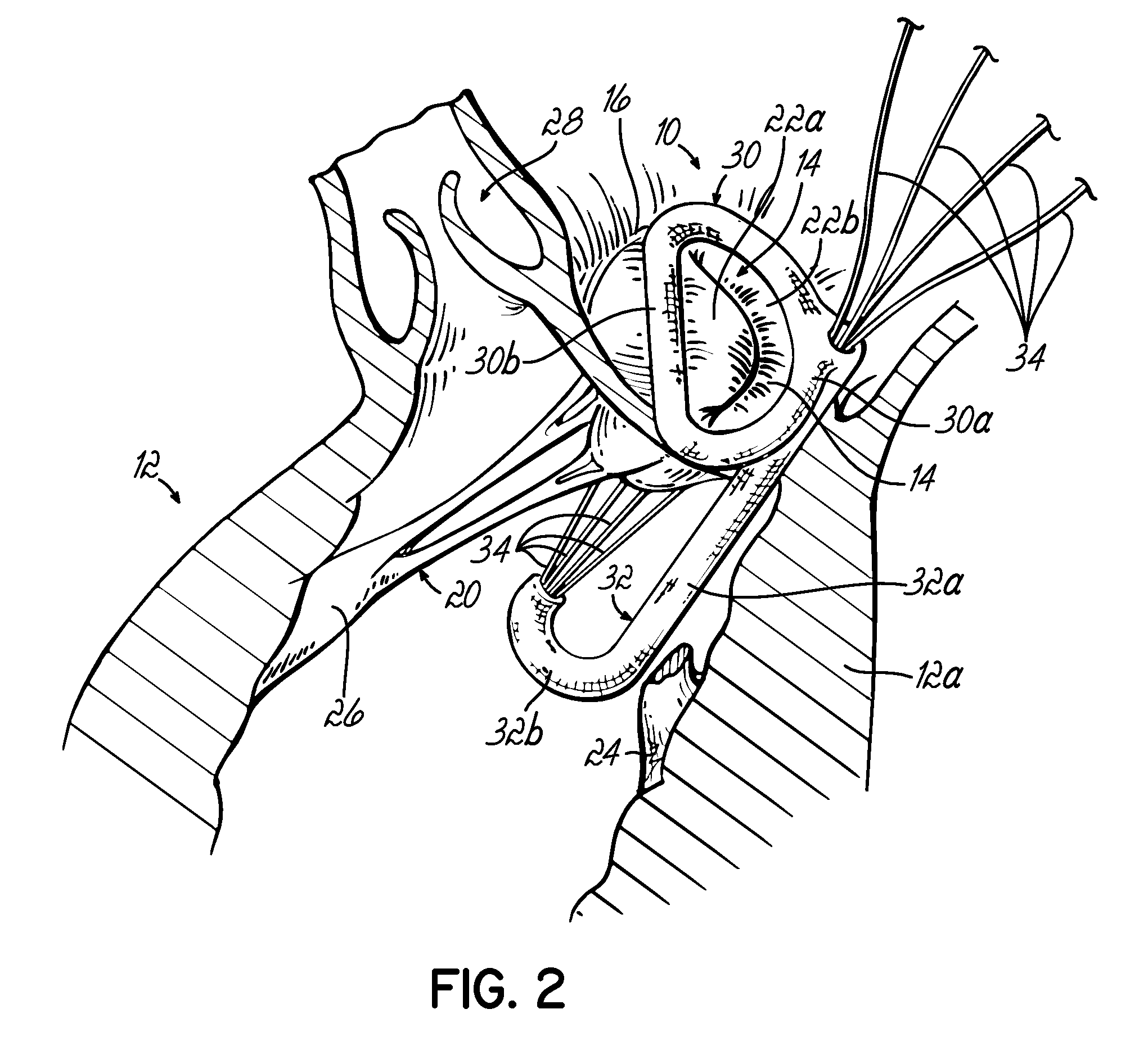 Heart valve repair apparatus and methods