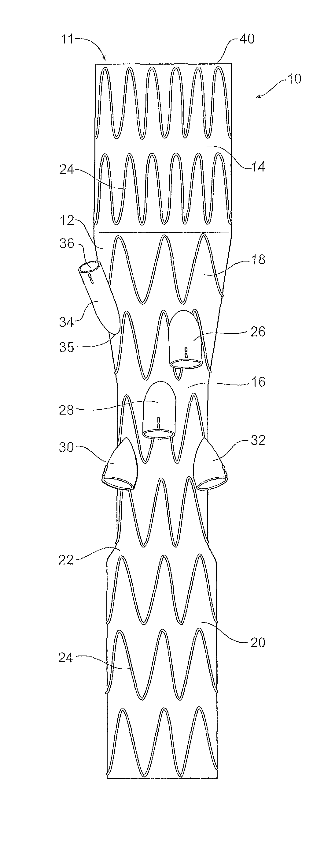 Paraplegia prevention stent graft