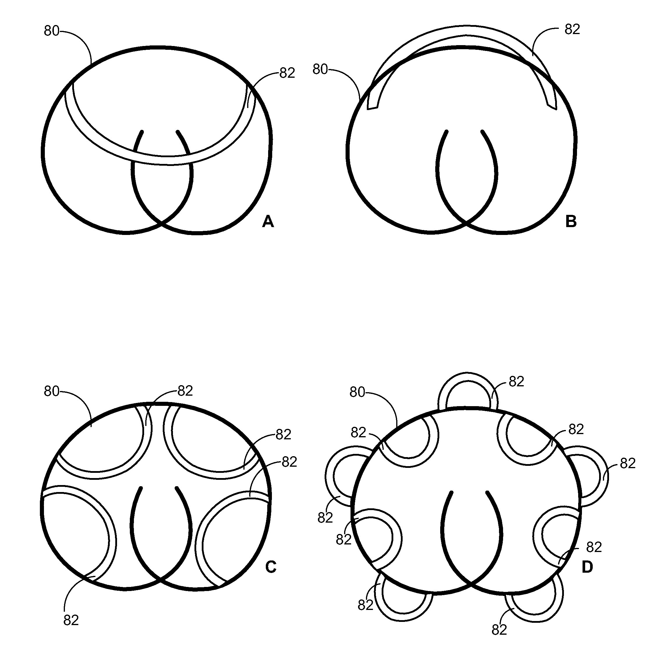 Implantable Drug Delivery Device and Methods for Treatment of the Bladder and Other Body Vesicles or Lumens