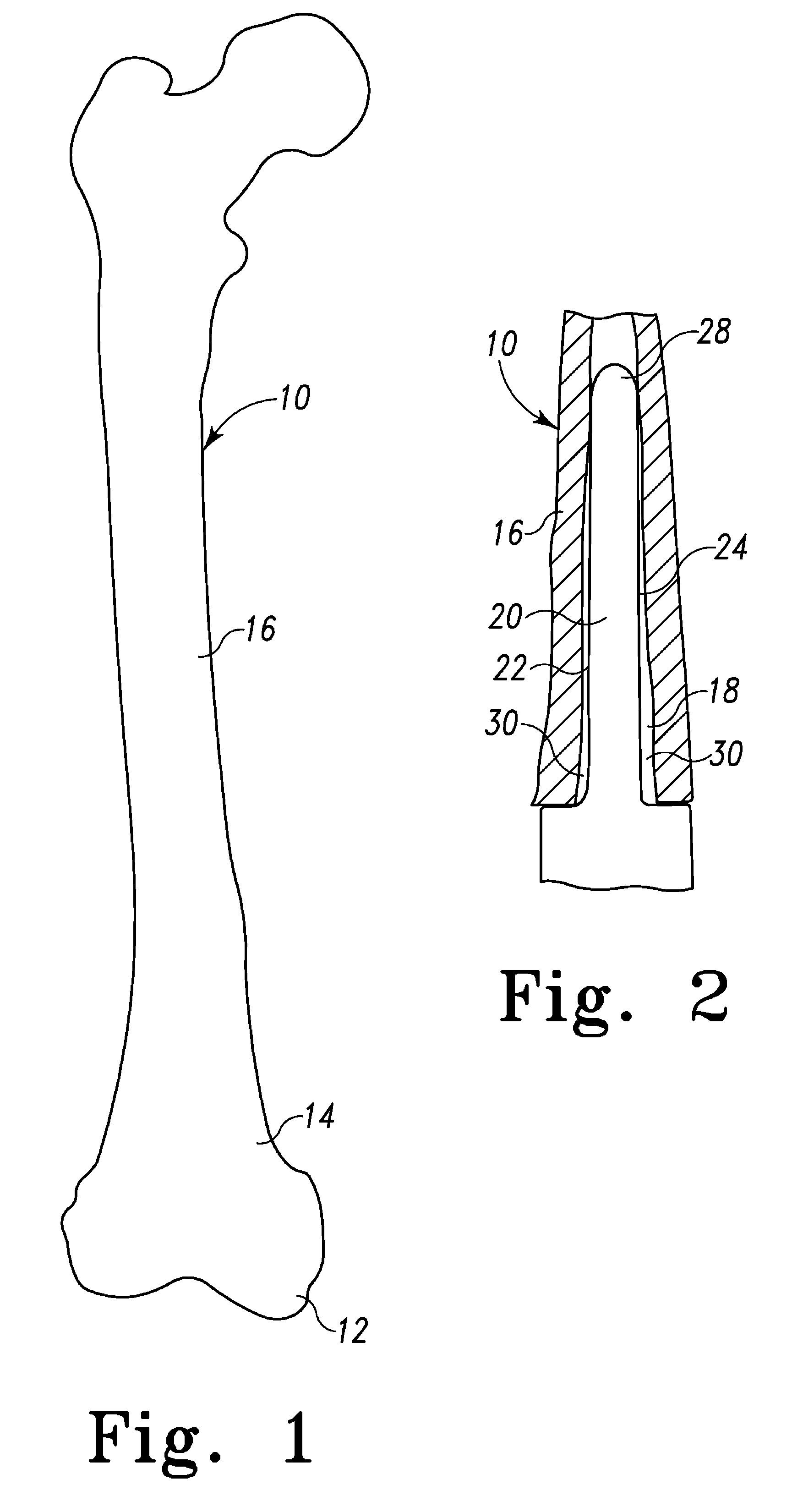 Modular implant system and method with diaphyseal implant and adapter