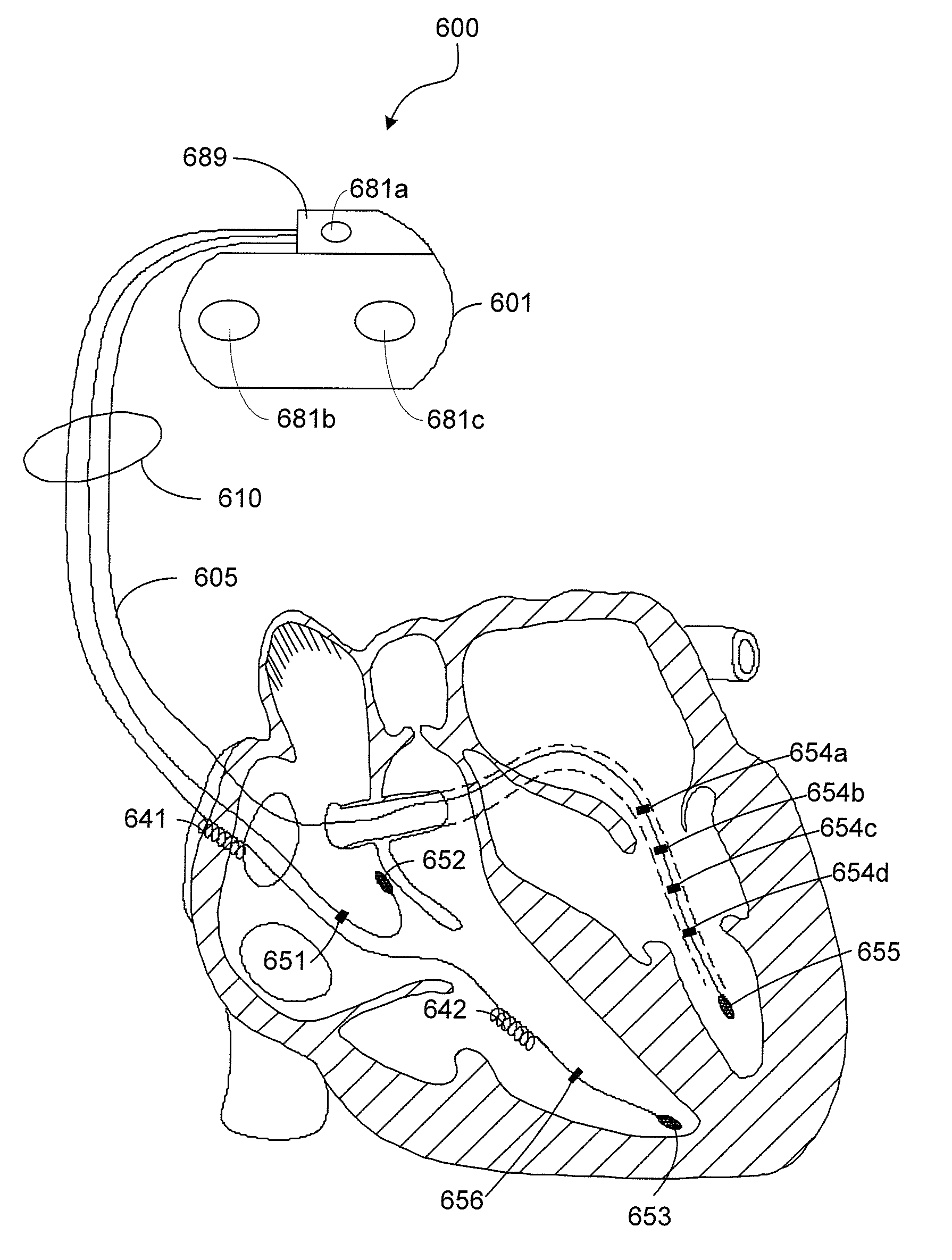 Methods and Apparatuses for Cardiac Resynchronization Therapy Mode Selection Based on Intrinsic Conduction