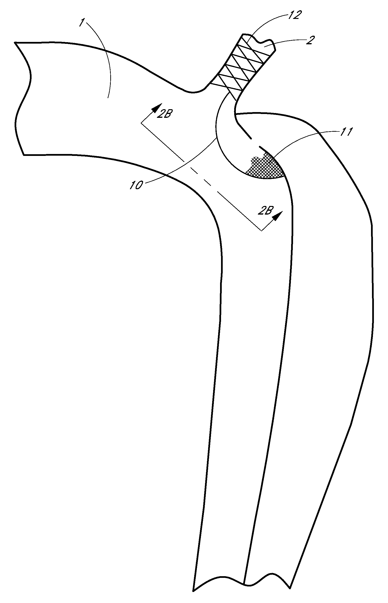 Percutaneous method and device to treat dissections