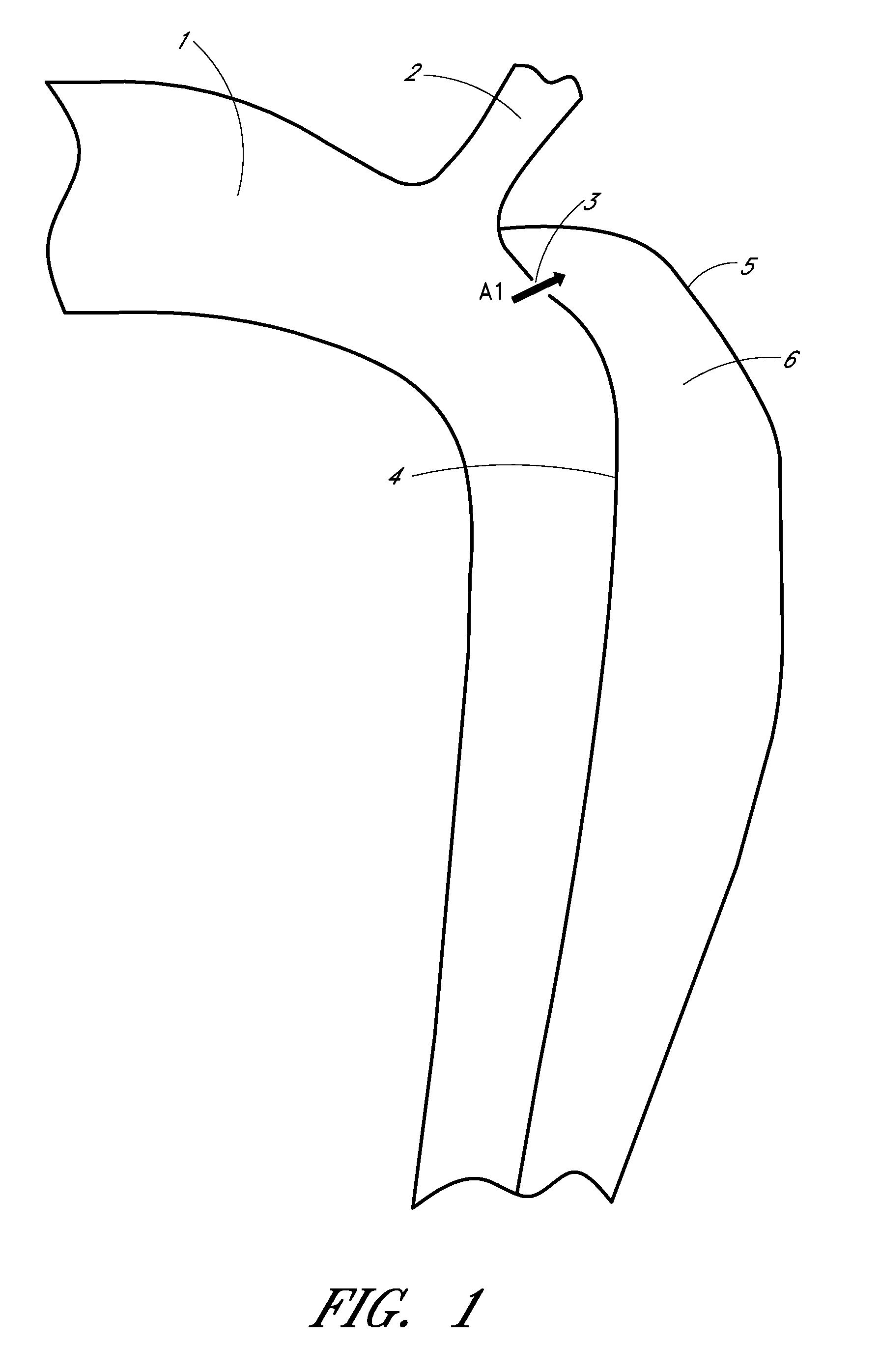 Percutaneous method and device to treat dissections