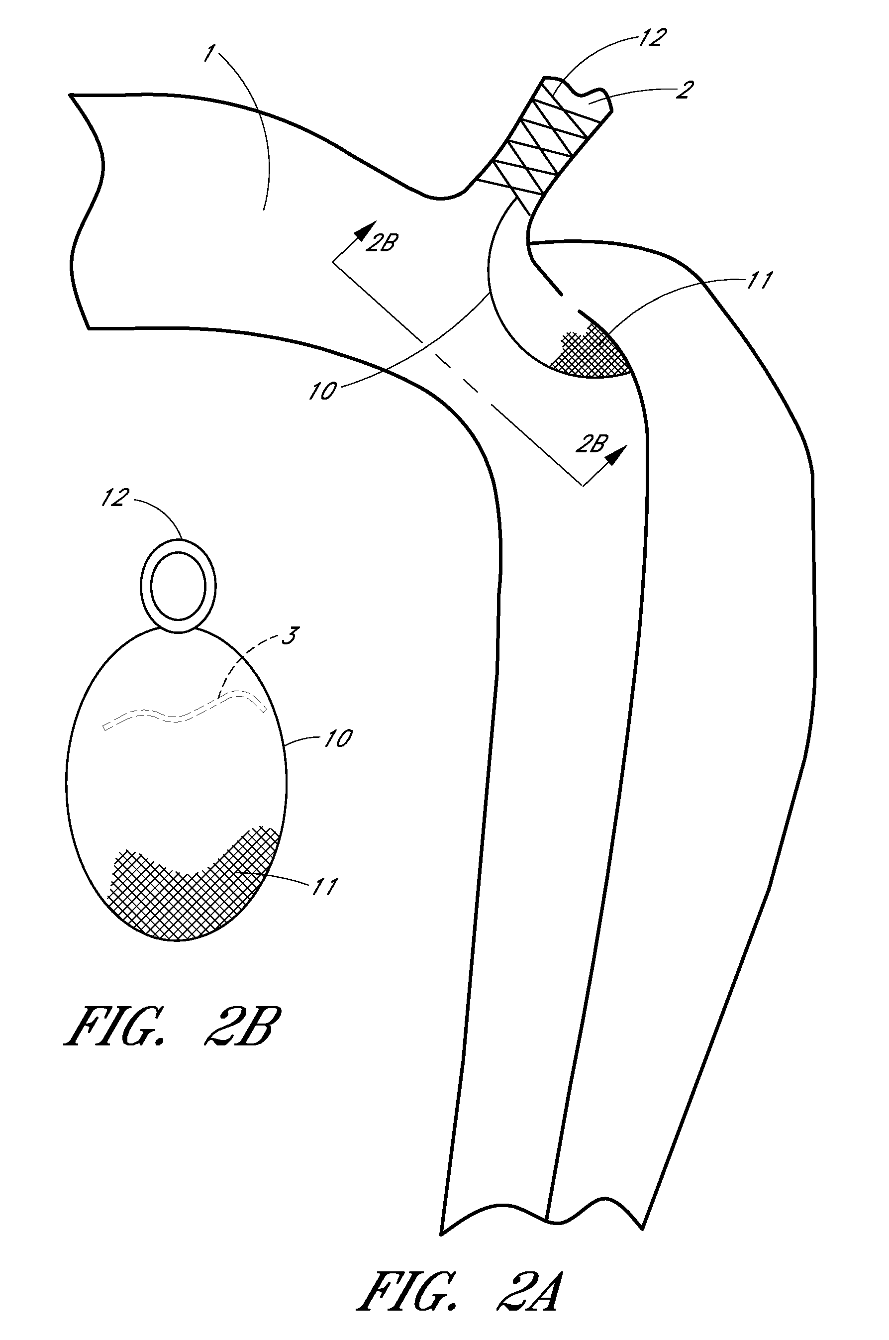 Percutaneous method and device to treat dissections