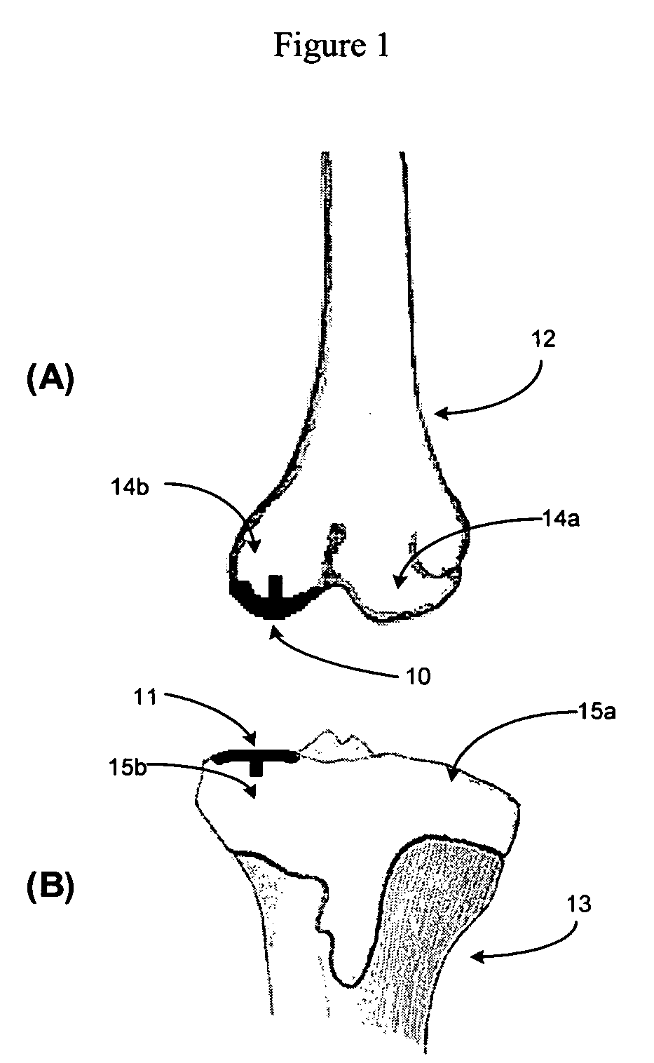 Site specific minimally invasive joint implants