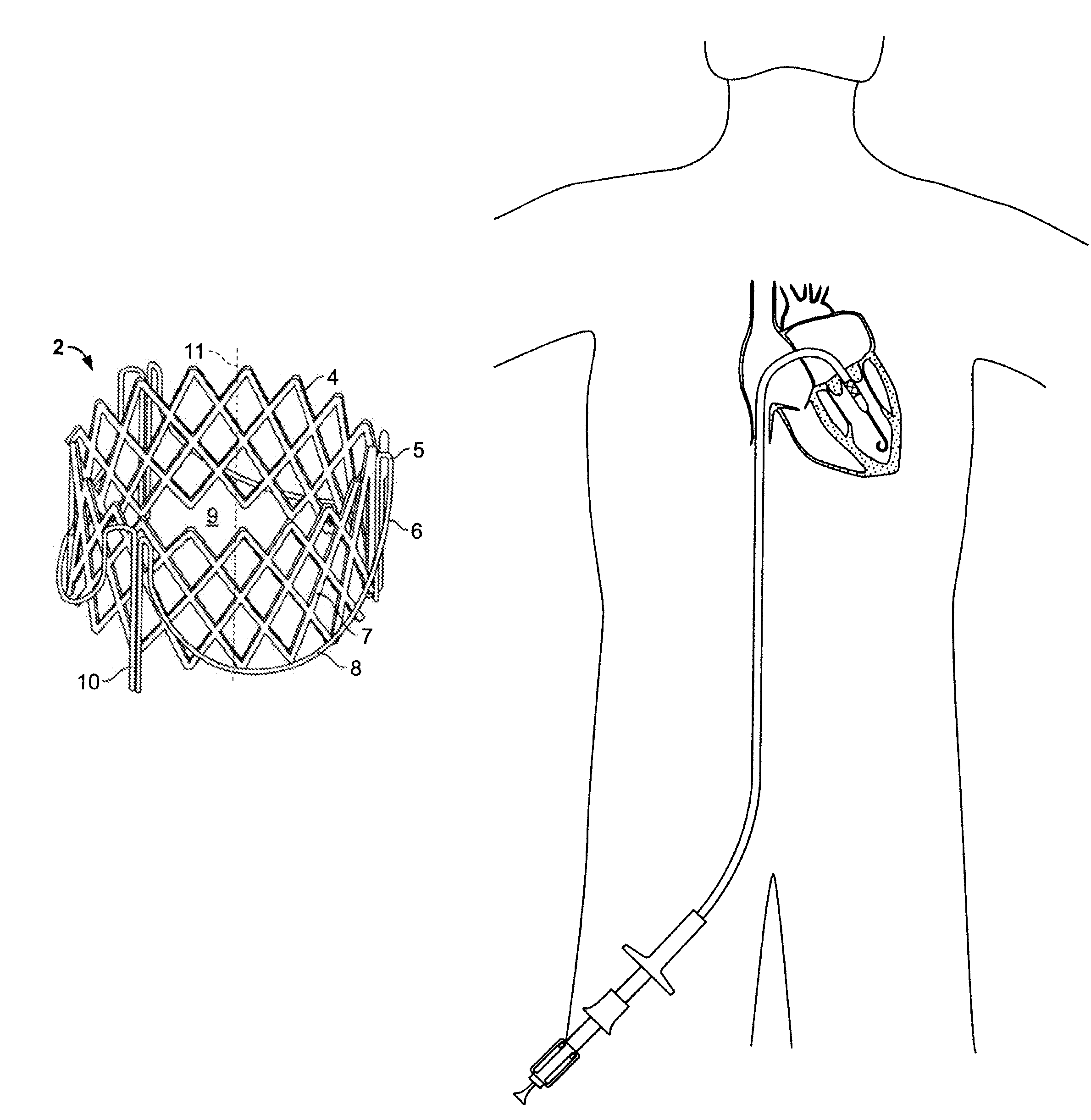 Methods for delivery of a sutureless pulmonary or mitral valve