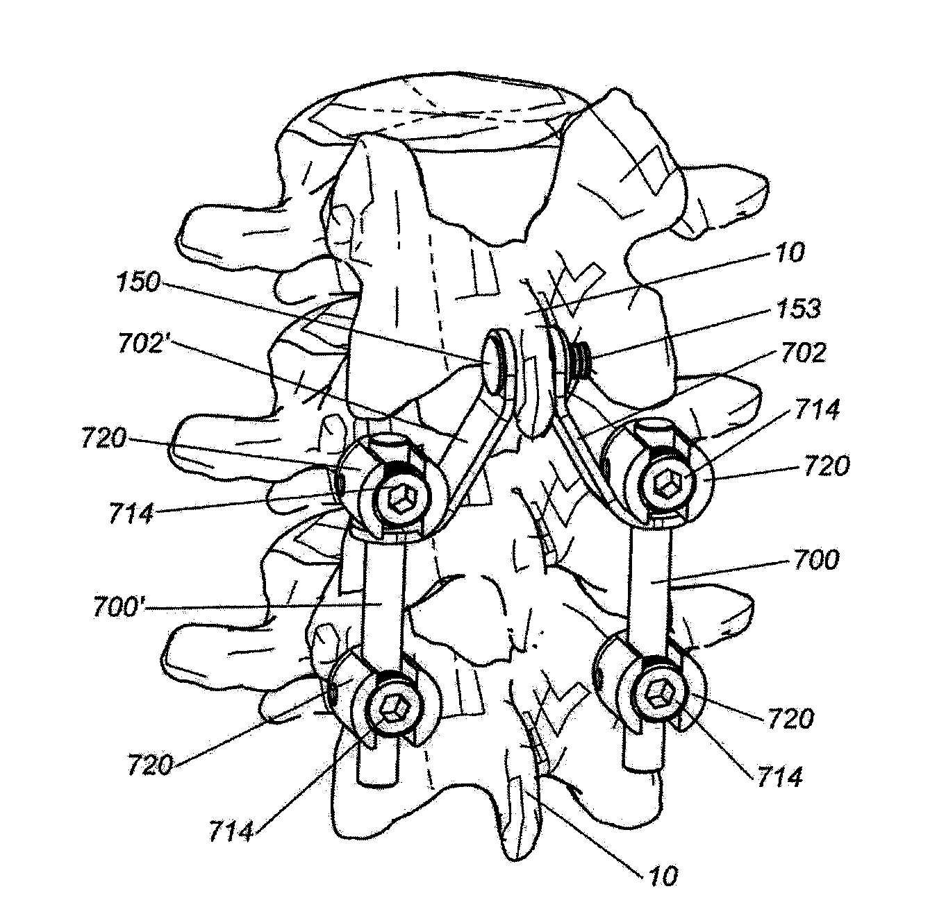 Intersegmental motion preservation system for use in the spine and methods for use thereof