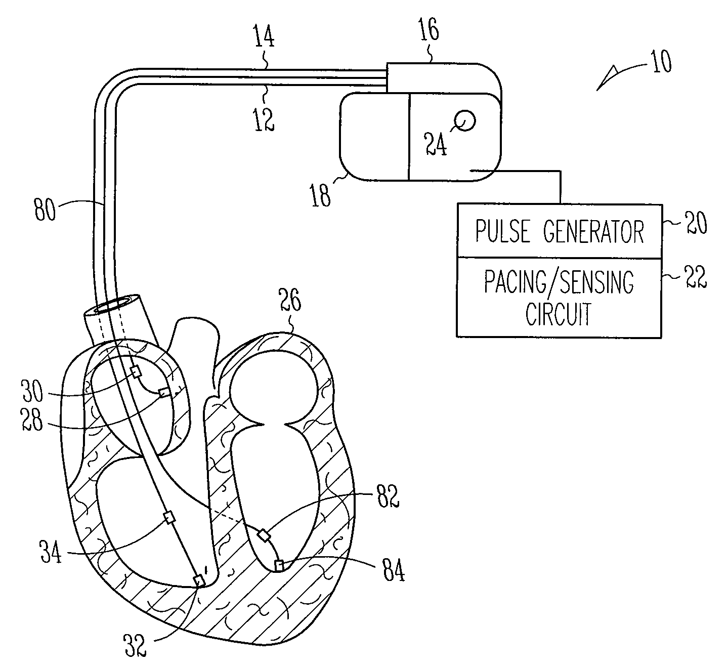 Autocapture pacing/sensing configuration