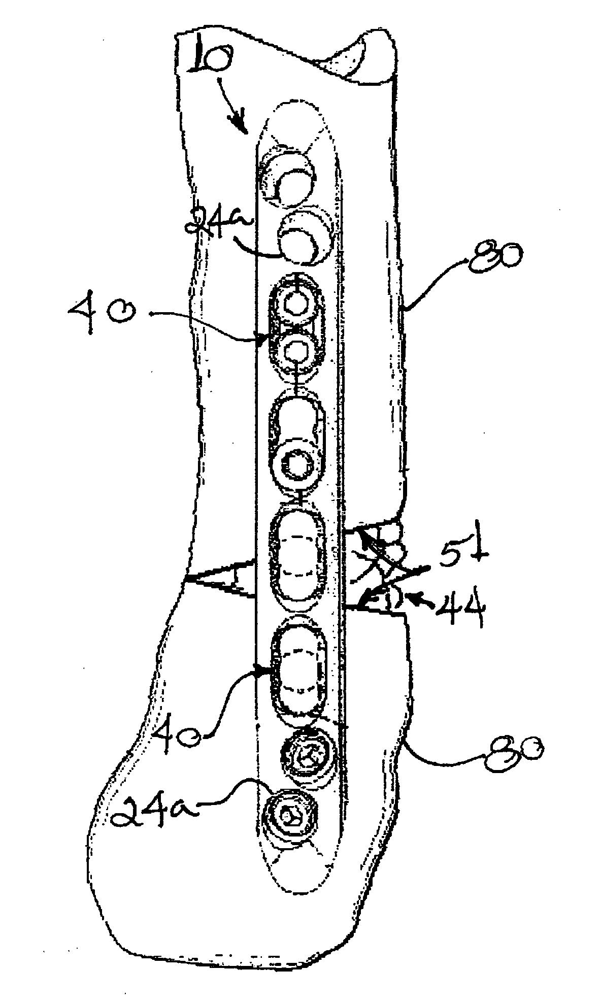 Bone plate with complex, adjacent holes joined by a bend relief zone