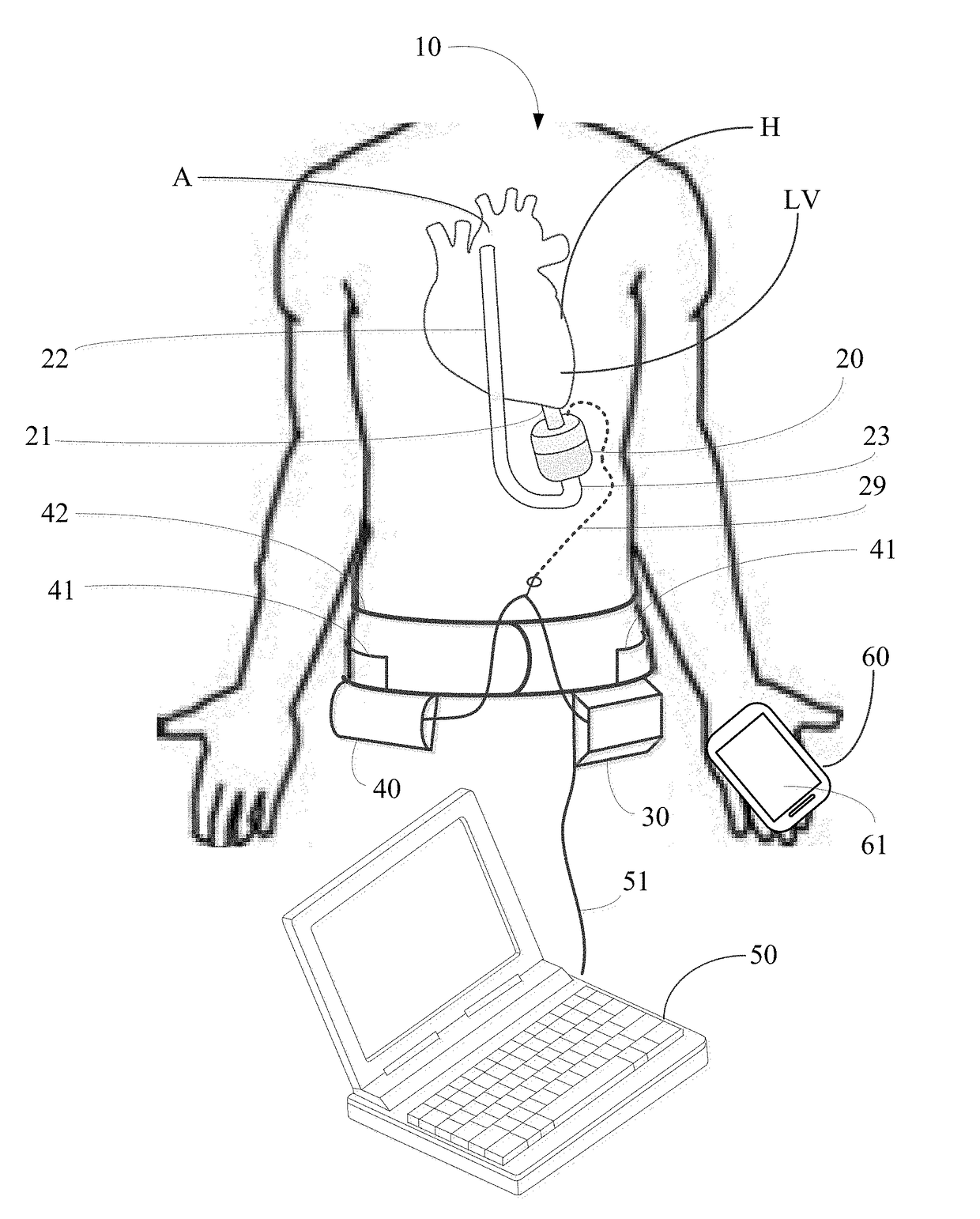 Implantable pump system having an undulating membrane