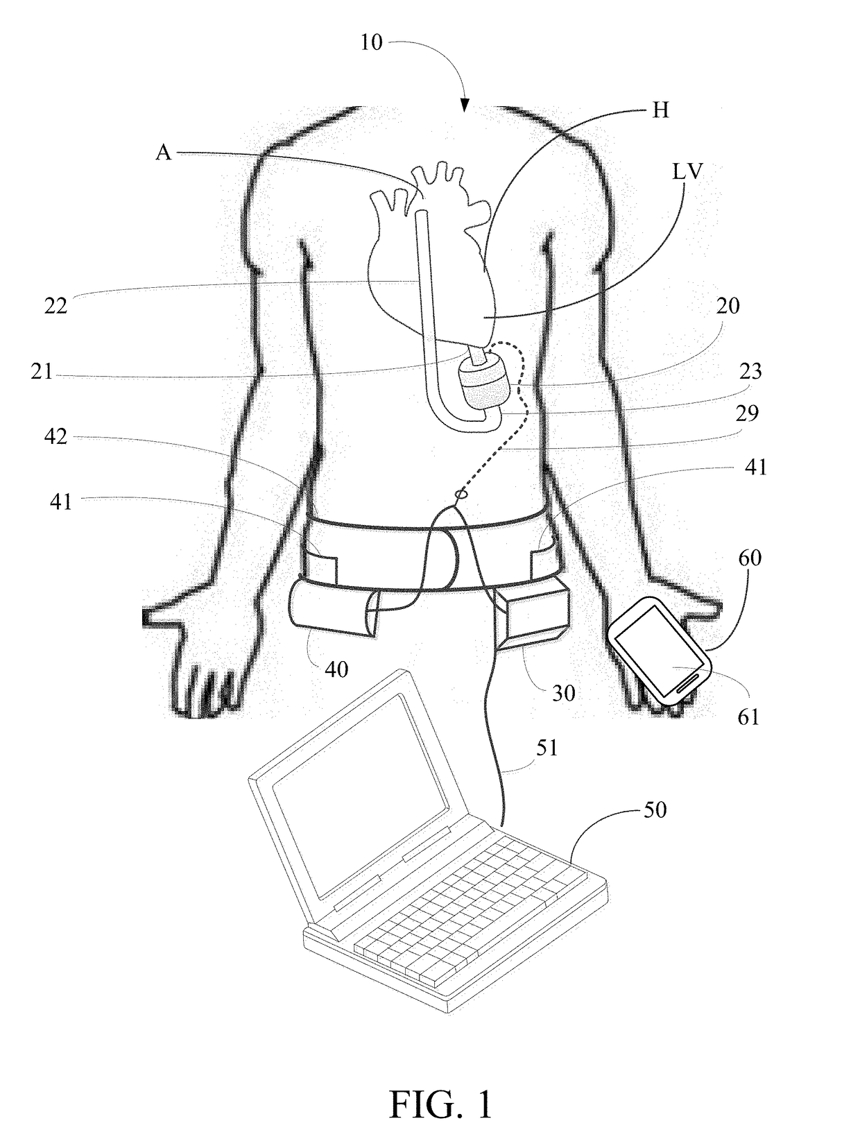 Implantable pump system having an undulating membrane