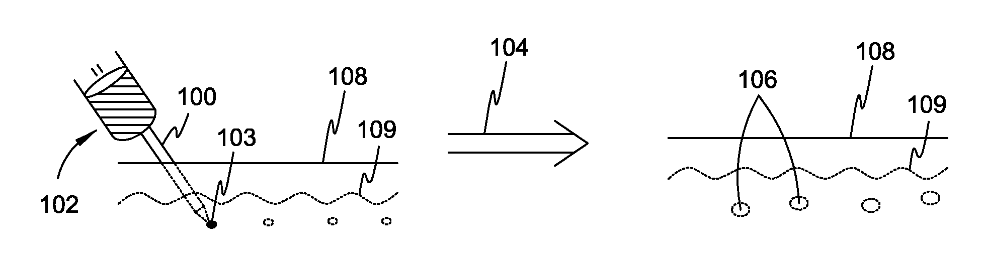 Methods for delivery of sub-surface array of absorber materials and methods of light irradiation therapy