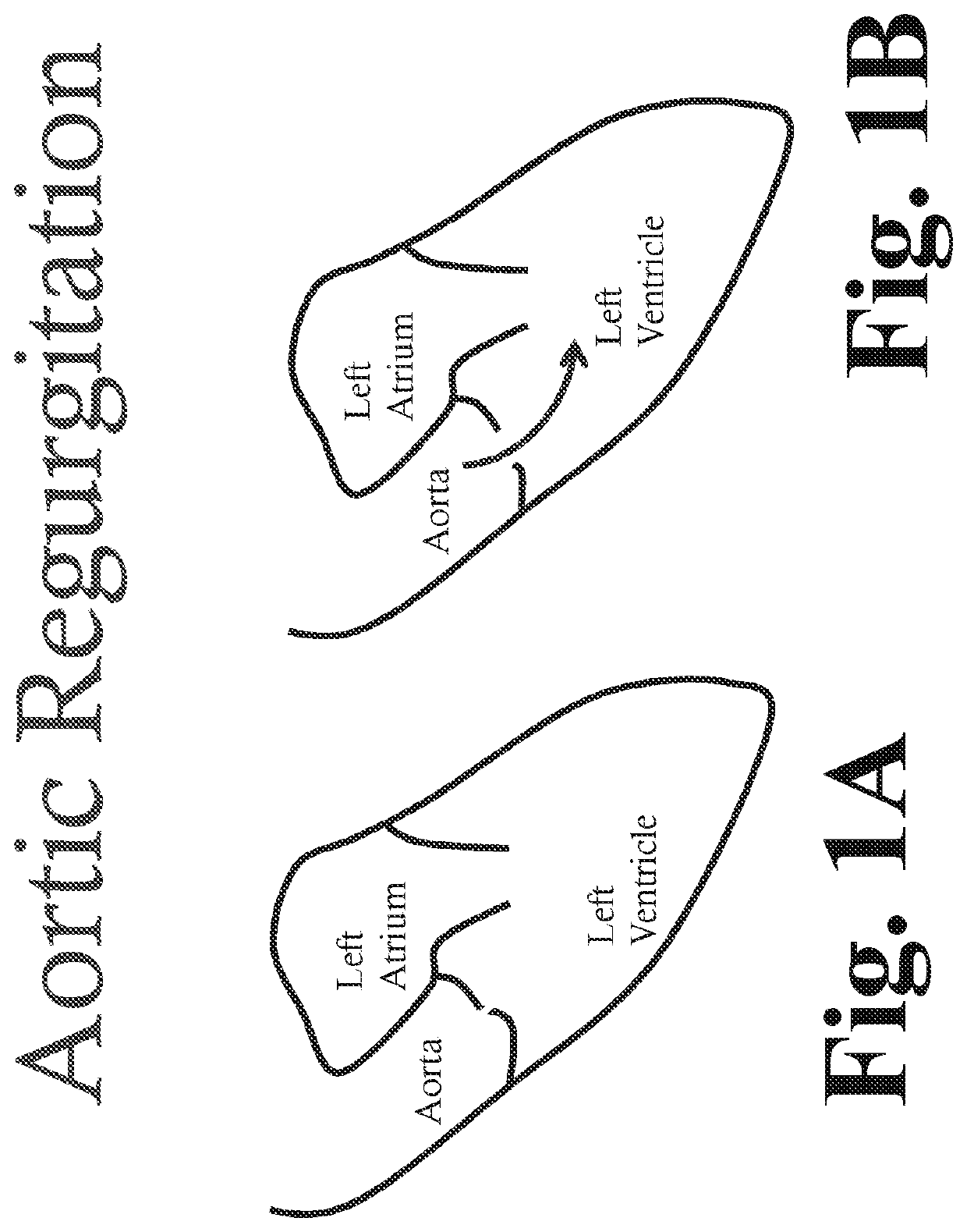 Transcatheter artificial cusp for valve insufficiency