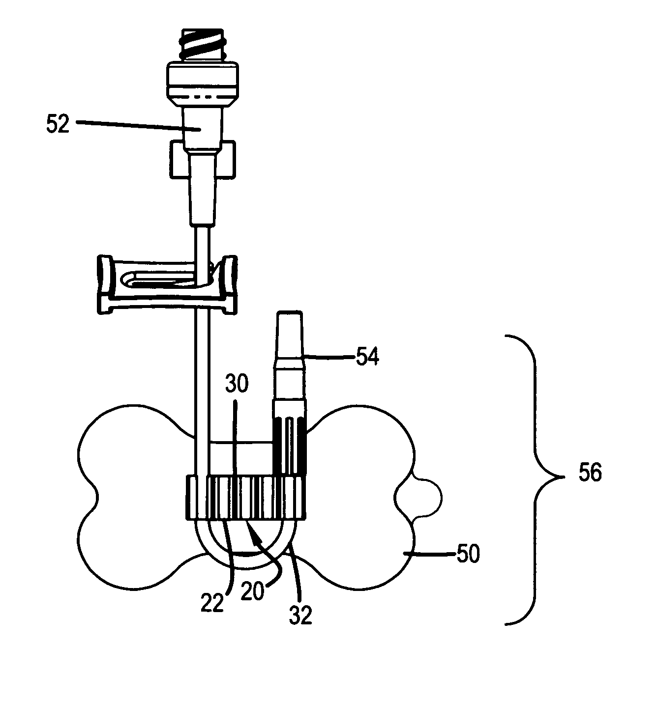 Site securement device for securing intravascular tubing