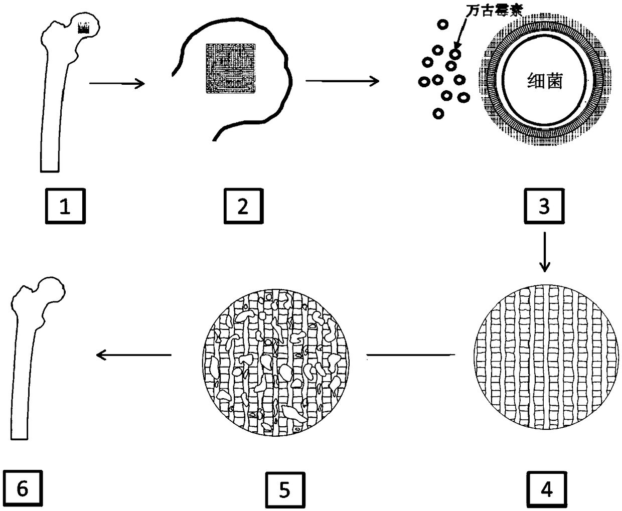 3D-printing PCL-PMMA-vancomycin anti-infection bone scaffold, and preparation method and application thereof