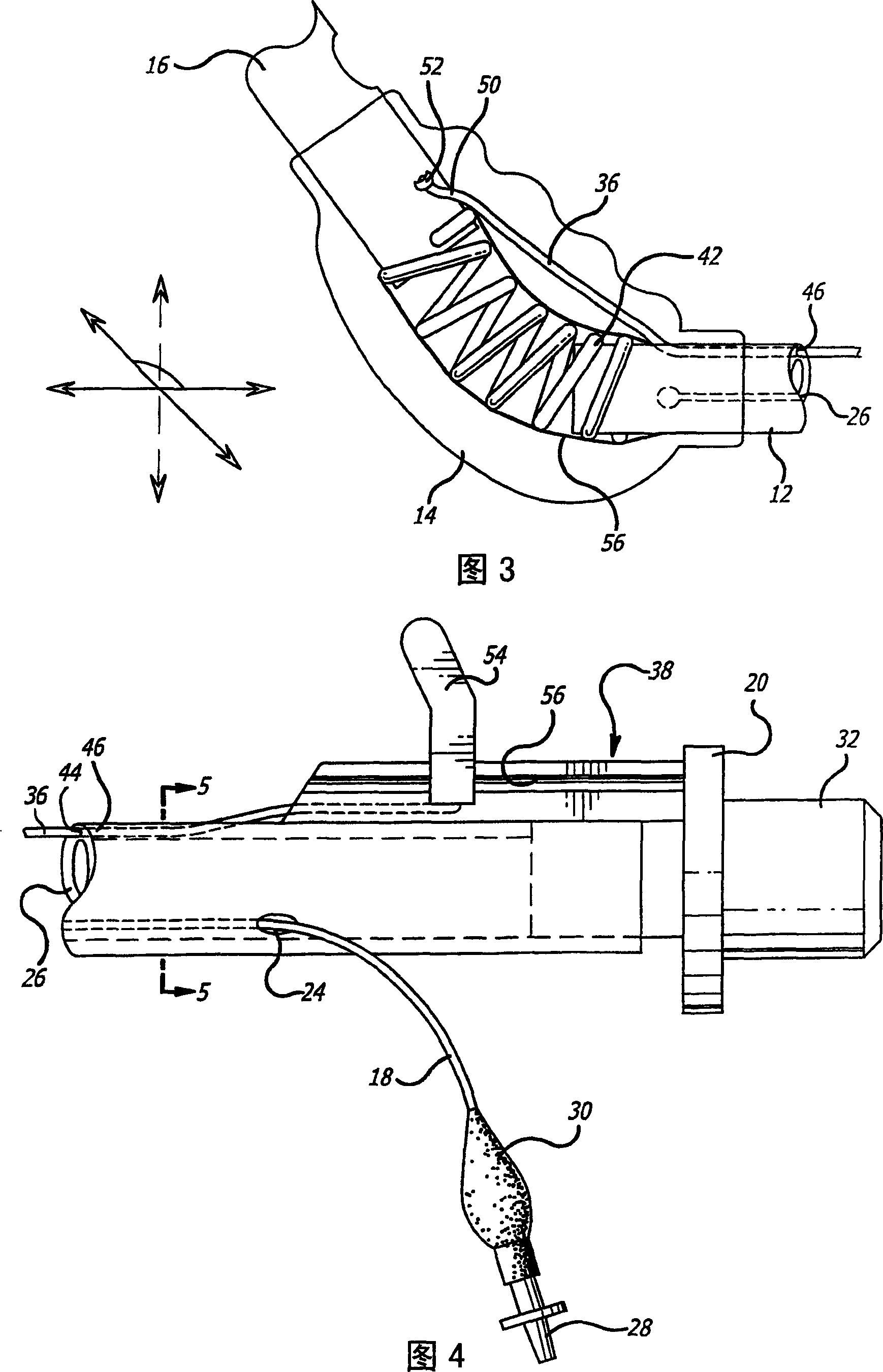 Endotracheal tube with tip directional control and position preserving mechanism