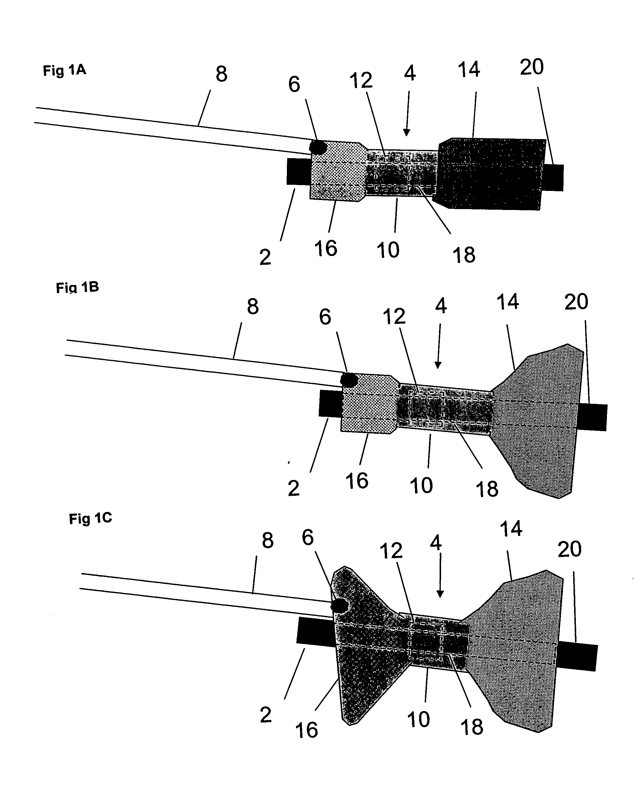 Pyloric valve corking device and method