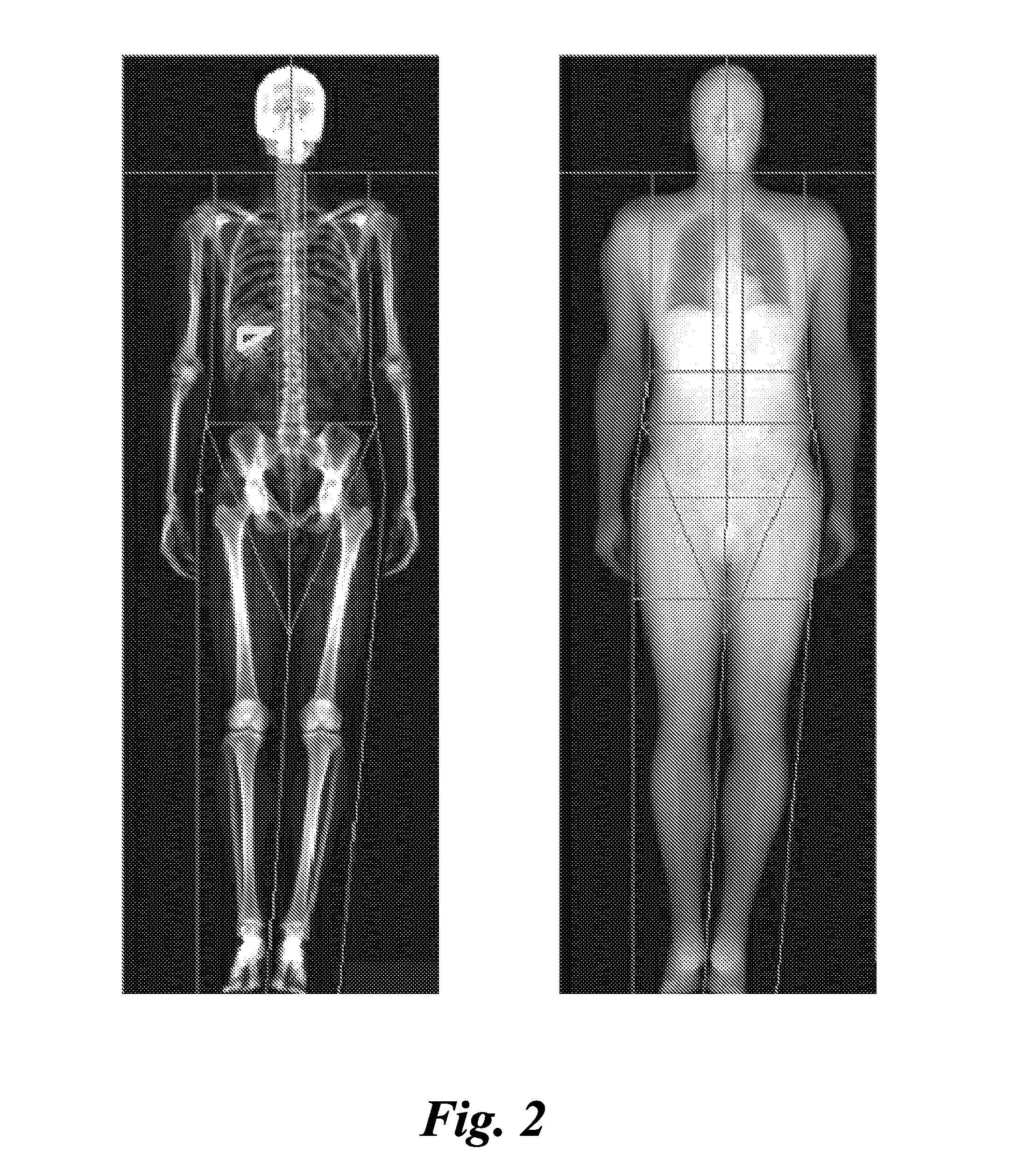 Method for measuring liver fat mass using dual-energy x-ray absorptiometry