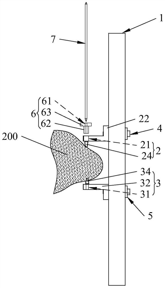 Percutaneous closed reduction patella fracture internal fixing device