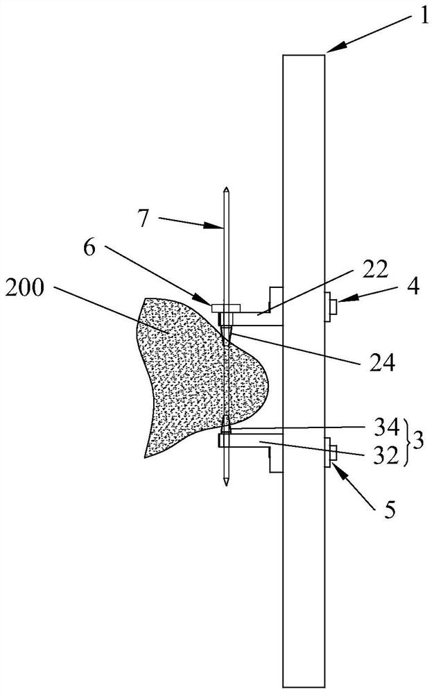 Percutaneous closed reduction patella fracture internal fixing device