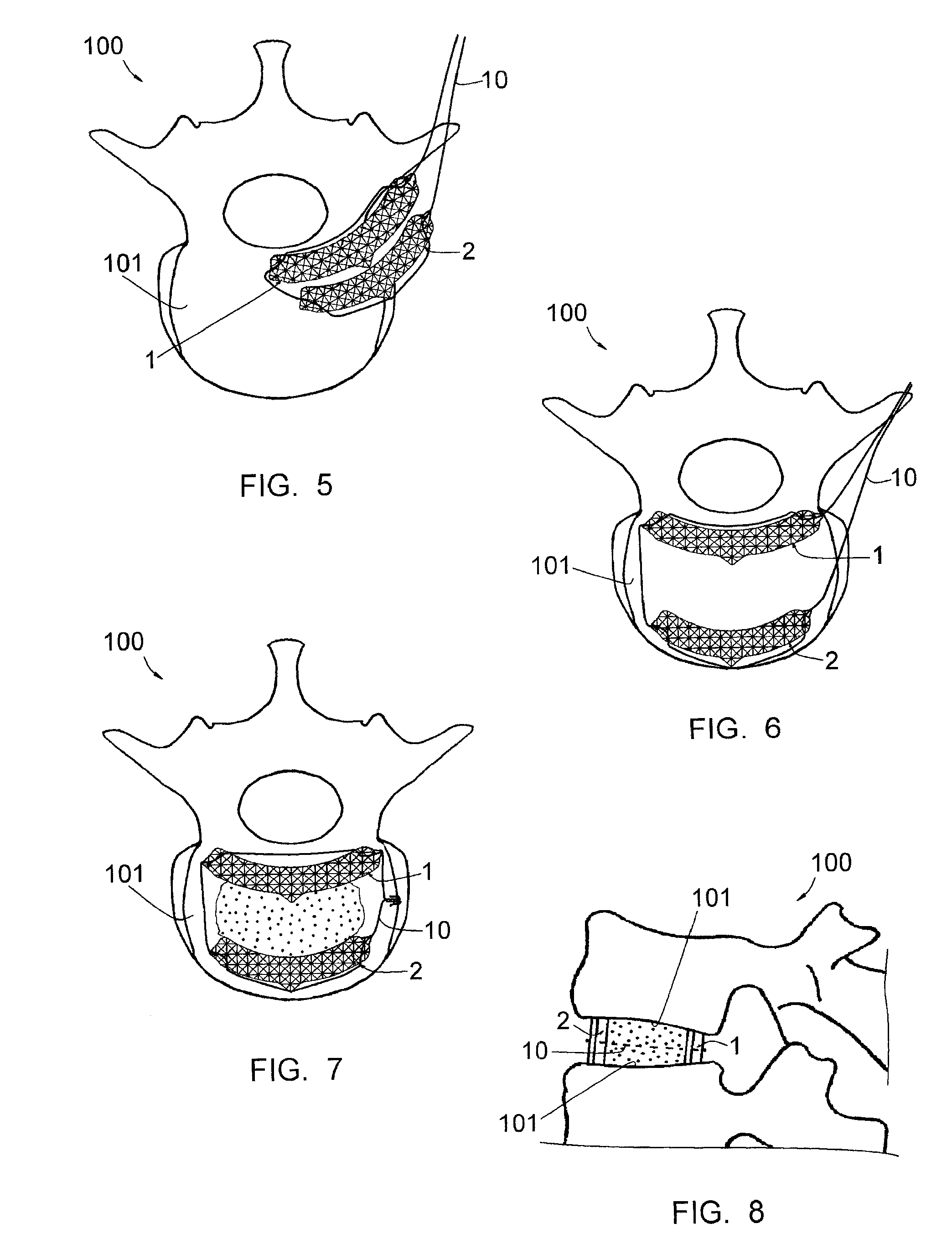 Intervertebral implant to immobilize one vertebra relative to another