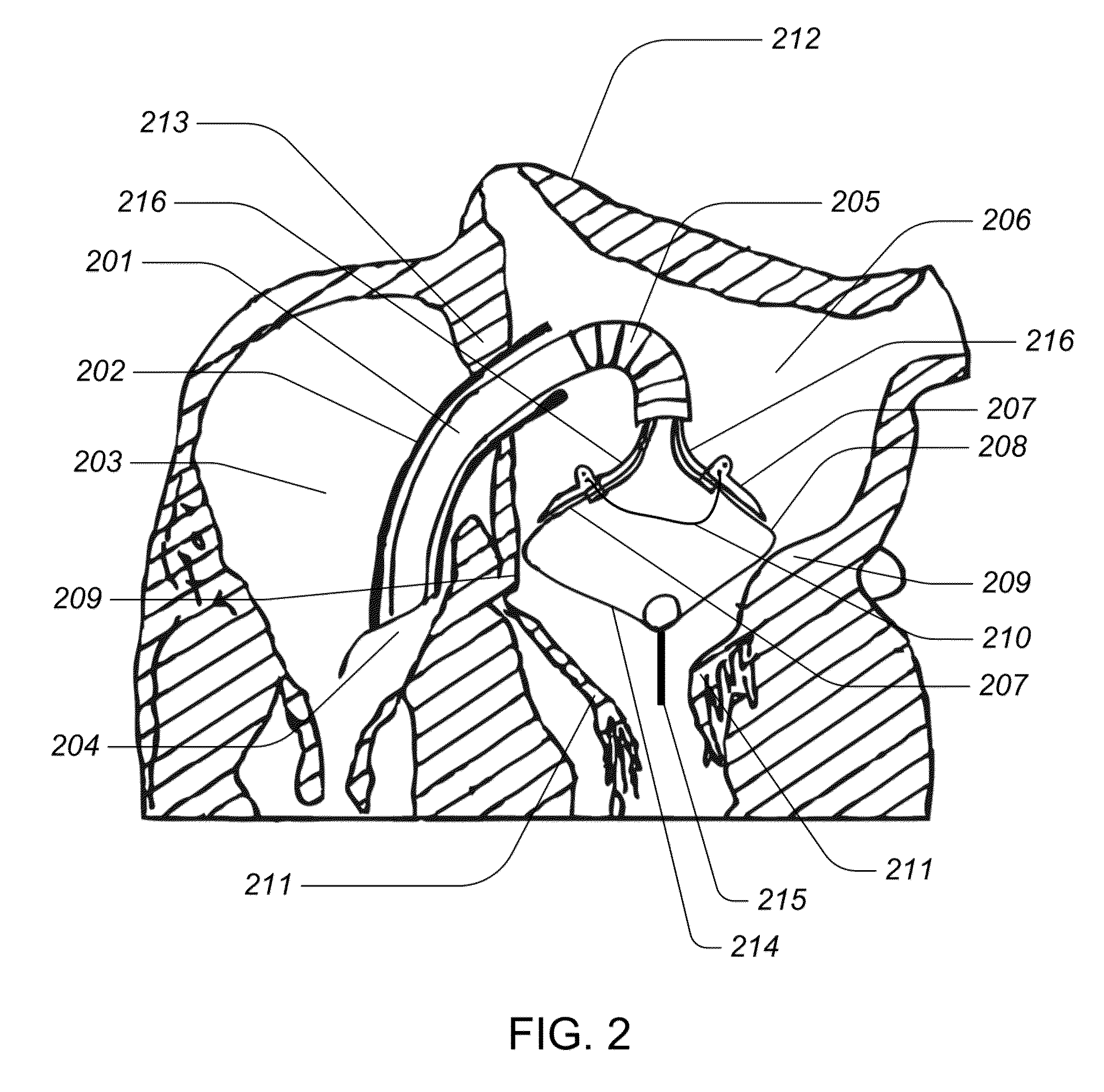 Medical device, kit and method for constricting tissue or a bodily orifice, for example, a mitral valve