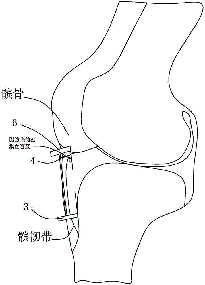 Infrapatellar fat pad excision device