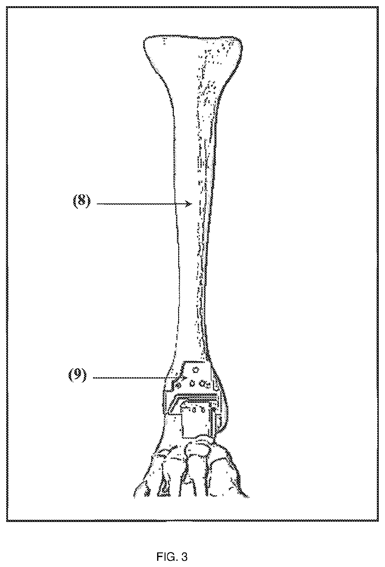 Three-in-one patient-specific template for usage in ankle replacements surgeries