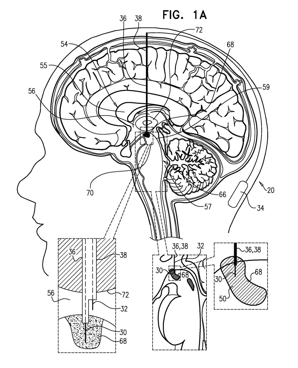 Electrical treatment of parkinson's disease