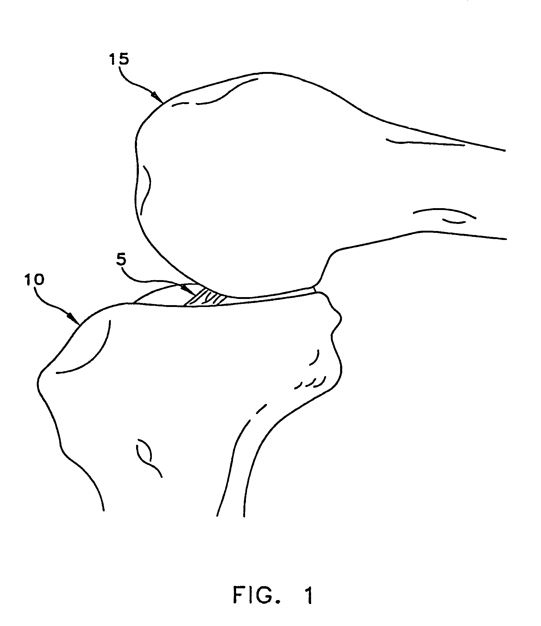 Apparatus and method for reconstructing a ligament