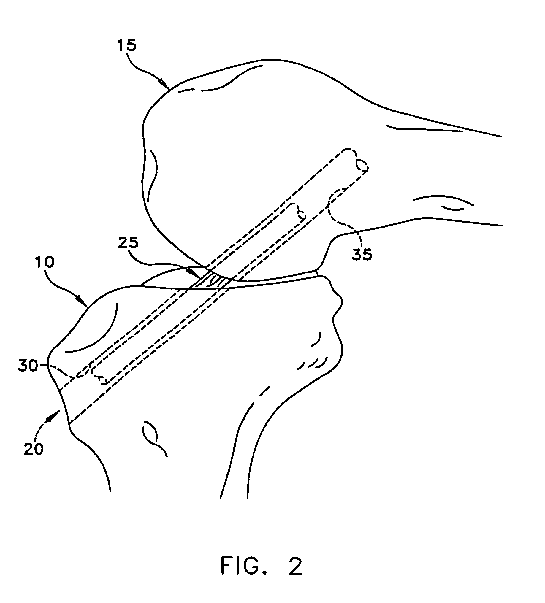 Apparatus and method for reconstructing a ligament