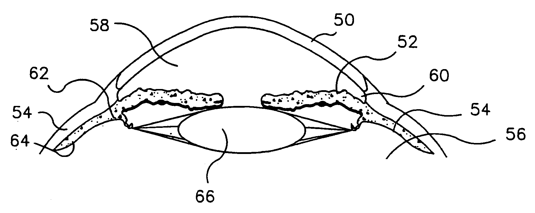 Refractive intraocular implant lens and method