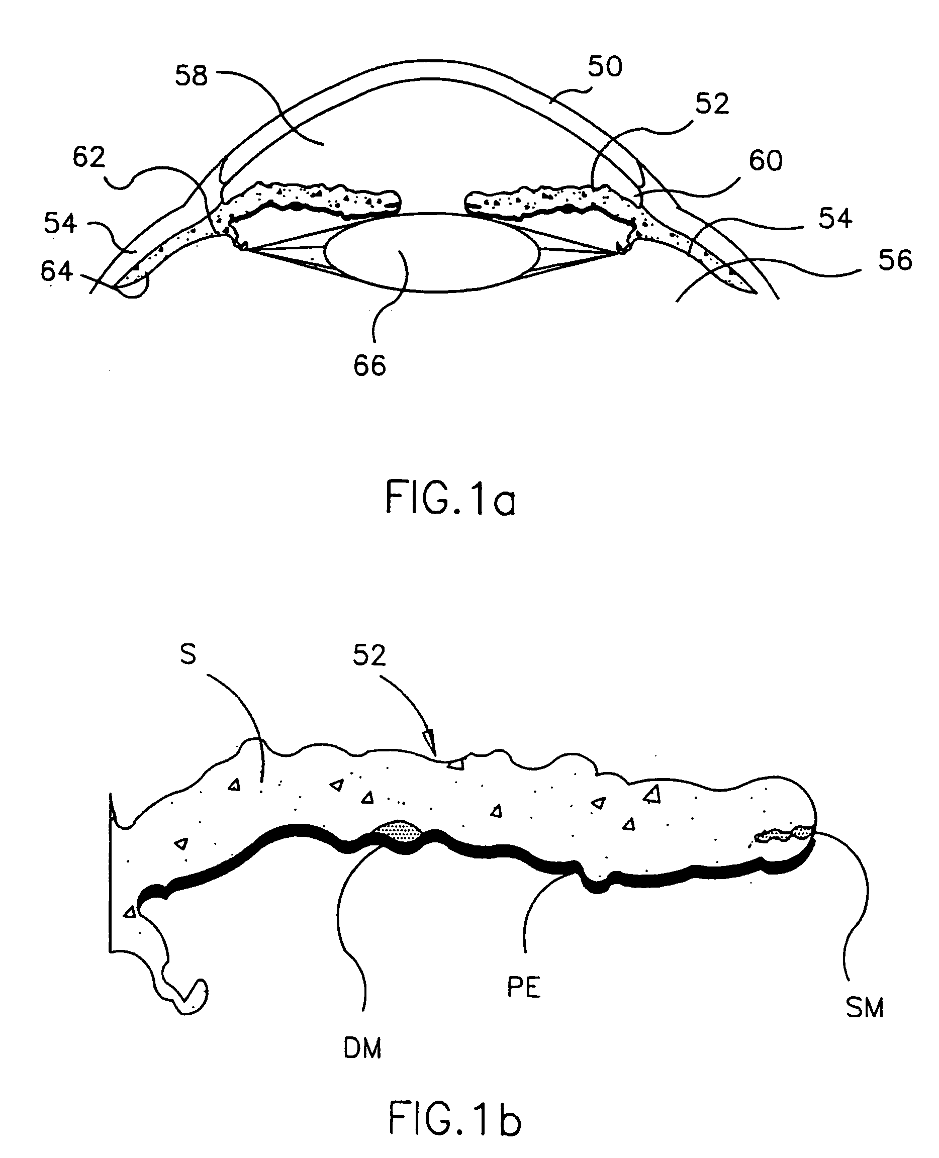 Refractive intraocular implant lens and method