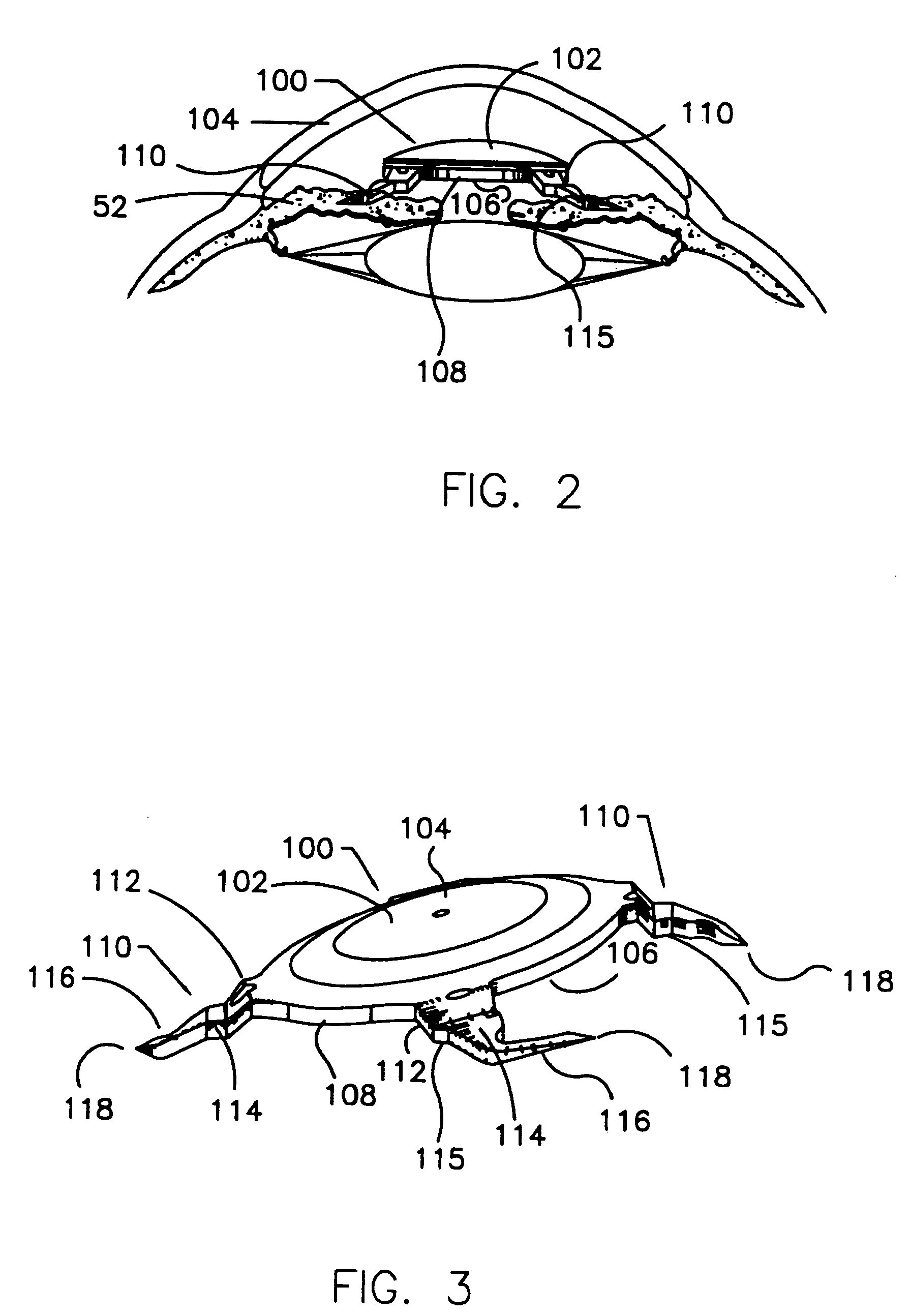 Refractive intraocular implant lens and method